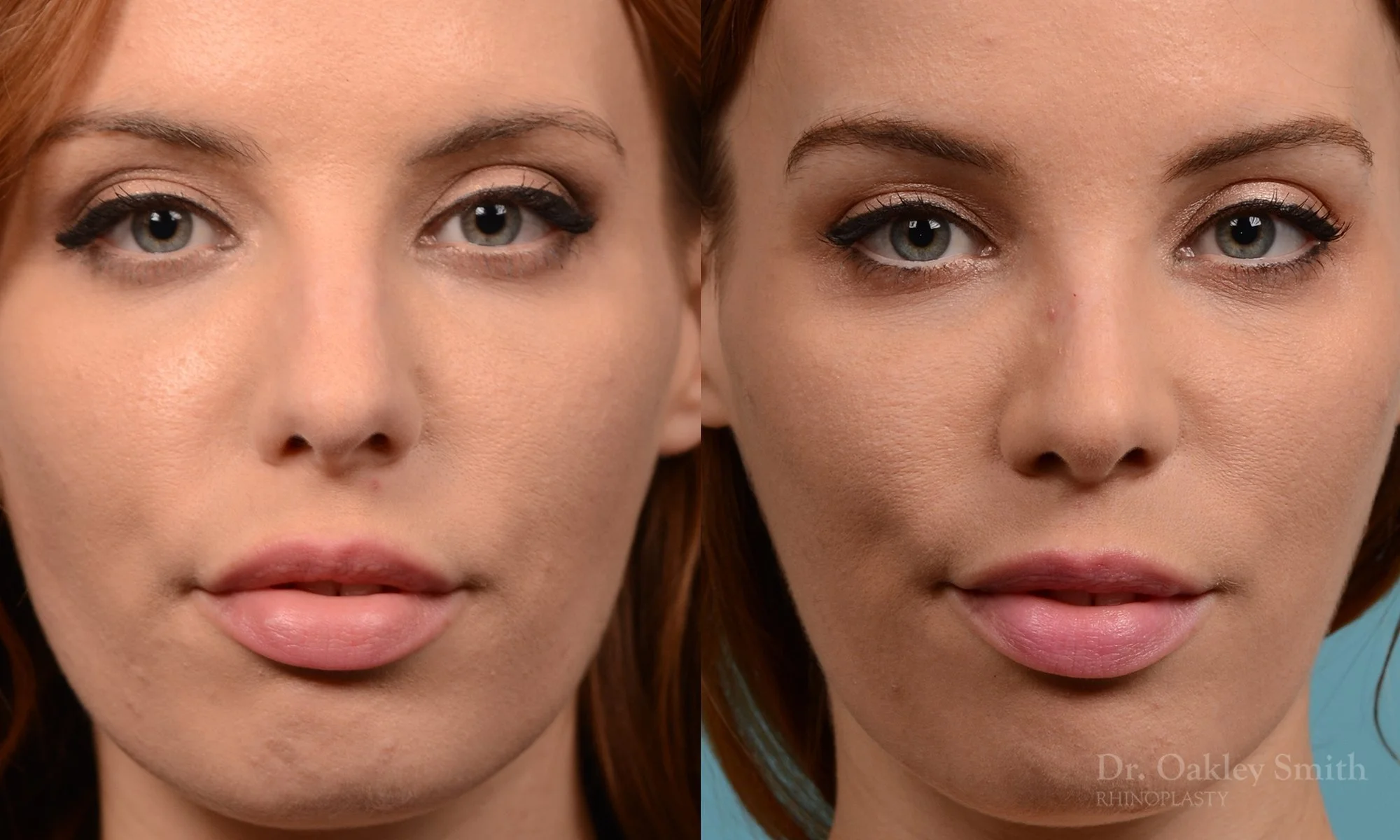 231A-rhinoplasty-dr-oakley-smith-toronto-nose-job-long-nose-bump-bridge-2.jpg