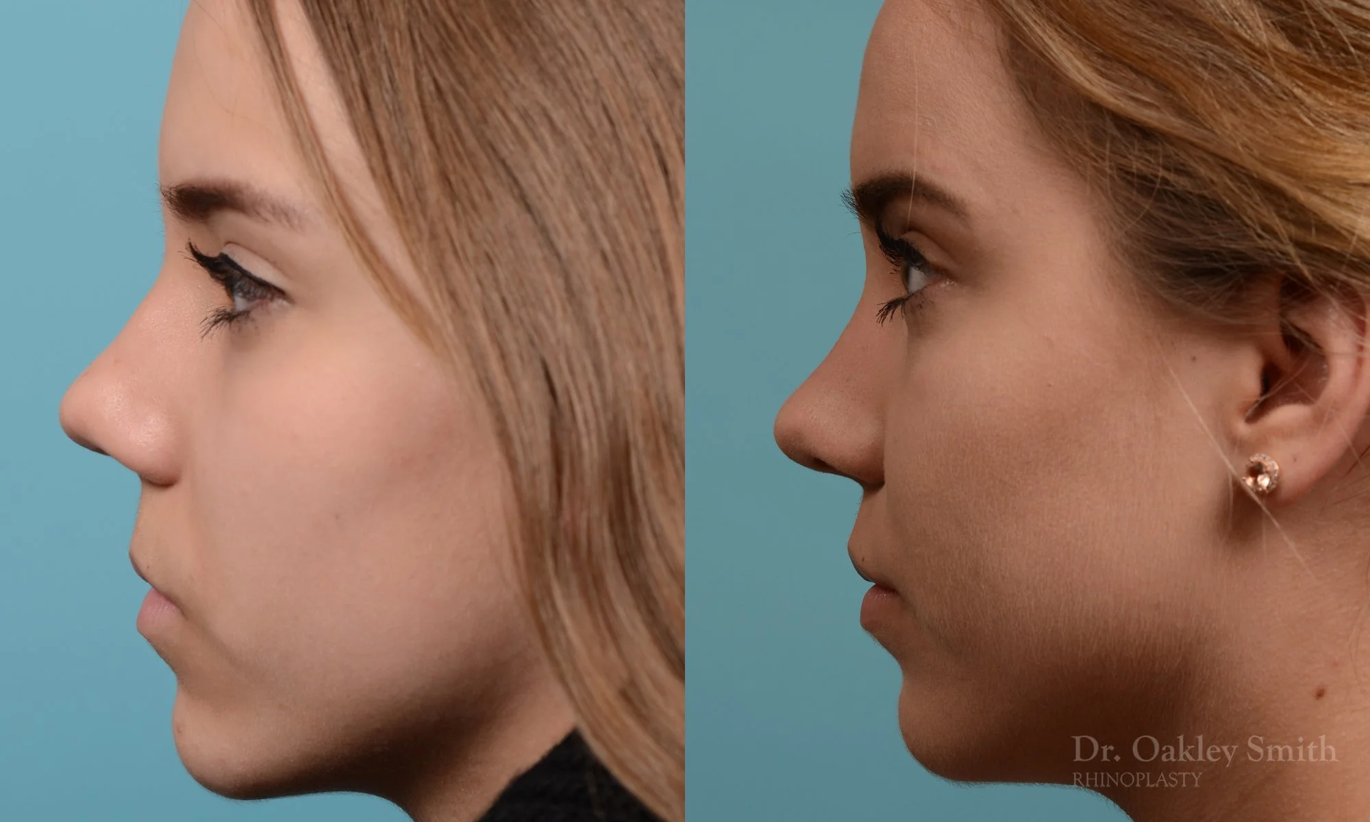 355E-rhinoplasty-dr-oakley-smith-toronto-nose-job.jpg