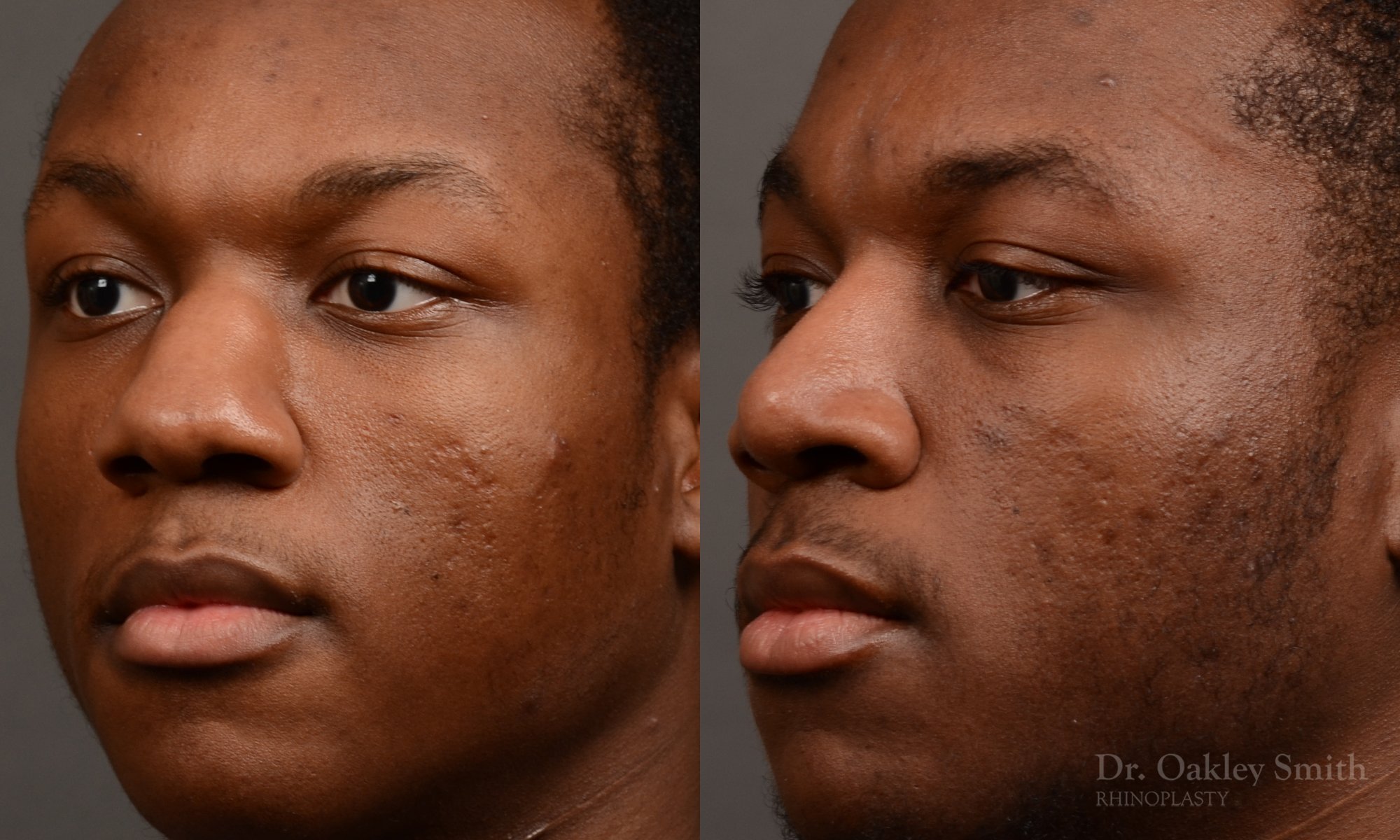 515D-male-rhinoplasty-dr-oakley-smith-toronto-top-surgeon-nose-job.jpg