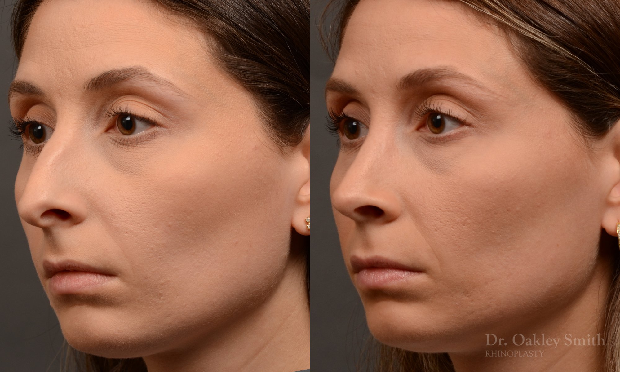 541D-rhinoplasty-dr-oakley-smith-toronto-nose-job.jpg