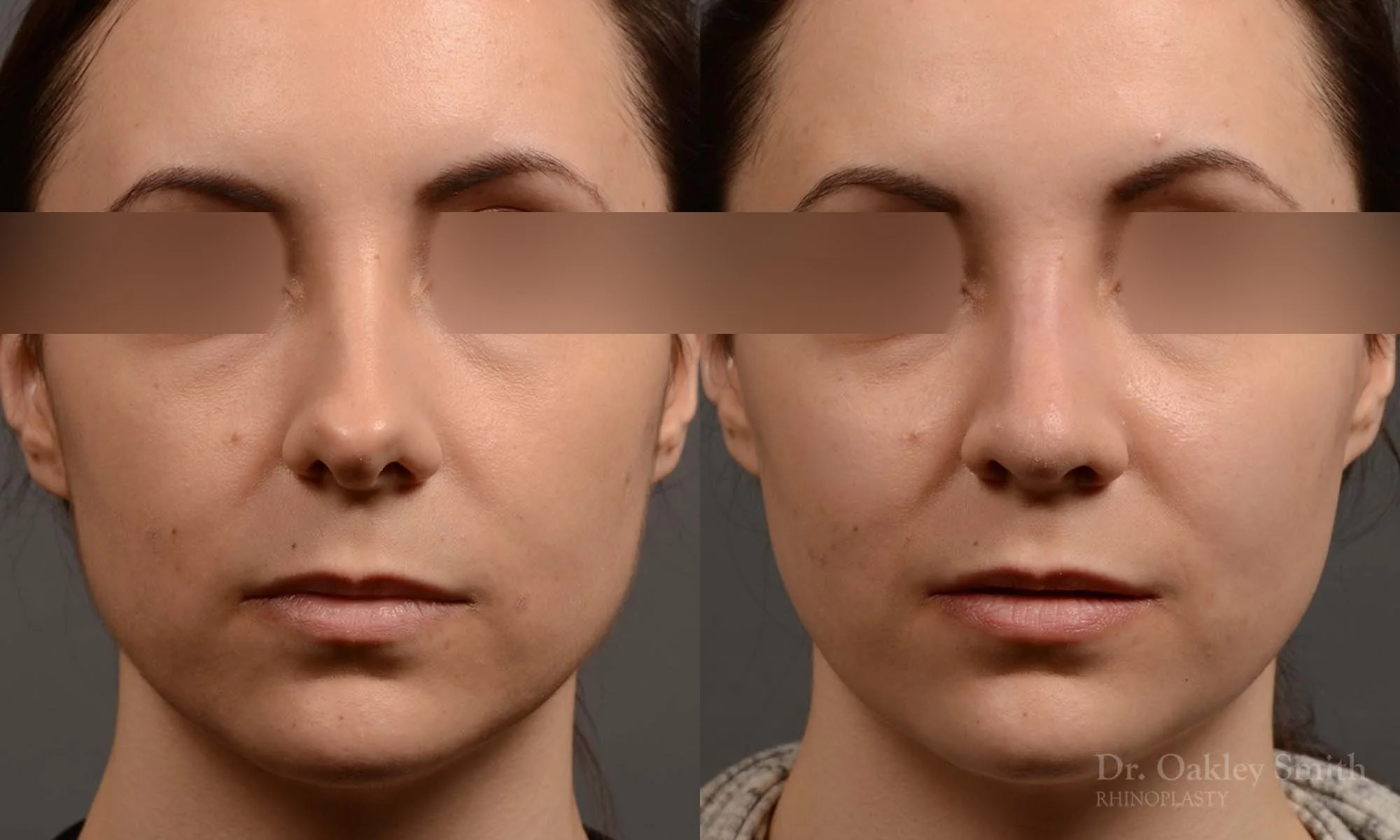 341A-rhinoplasty-dr-oakley-smith-toronto-nose-job.jpg