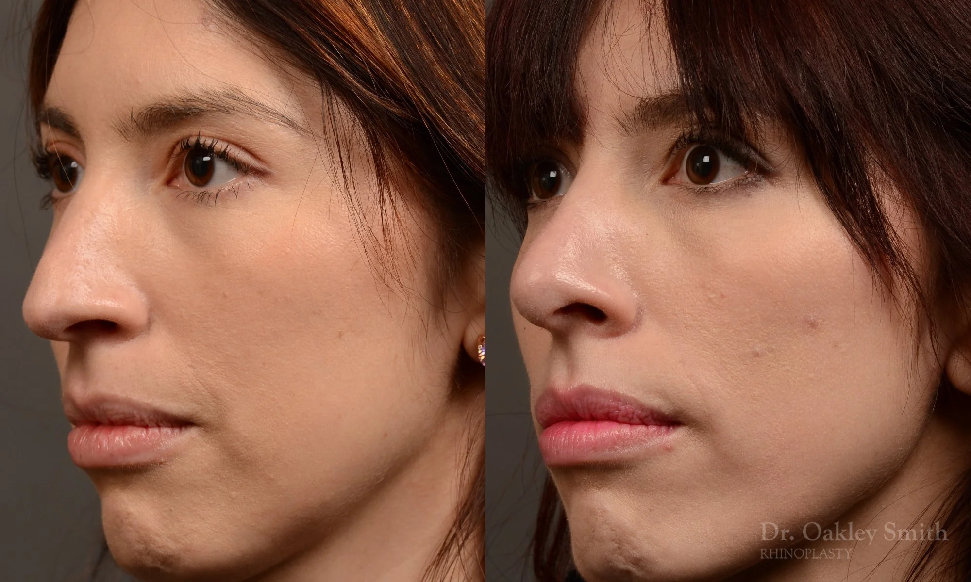 525D-rhinoplasty-dr-oakley-smith-toronto-top-surgeon-nose-job.jpg