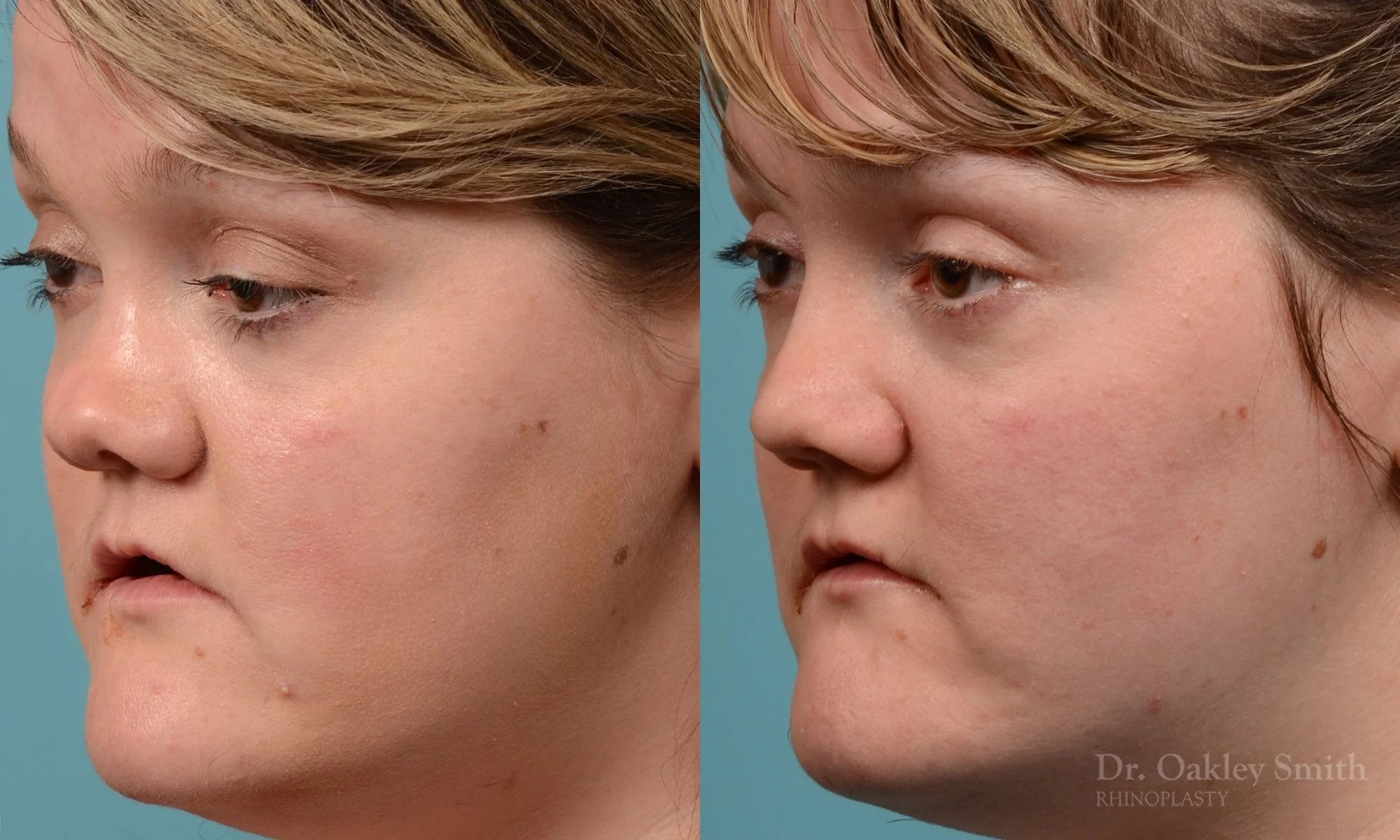241D-rhinioplasty-nose-job-dr-oakley-smith-toronto-1.jpg