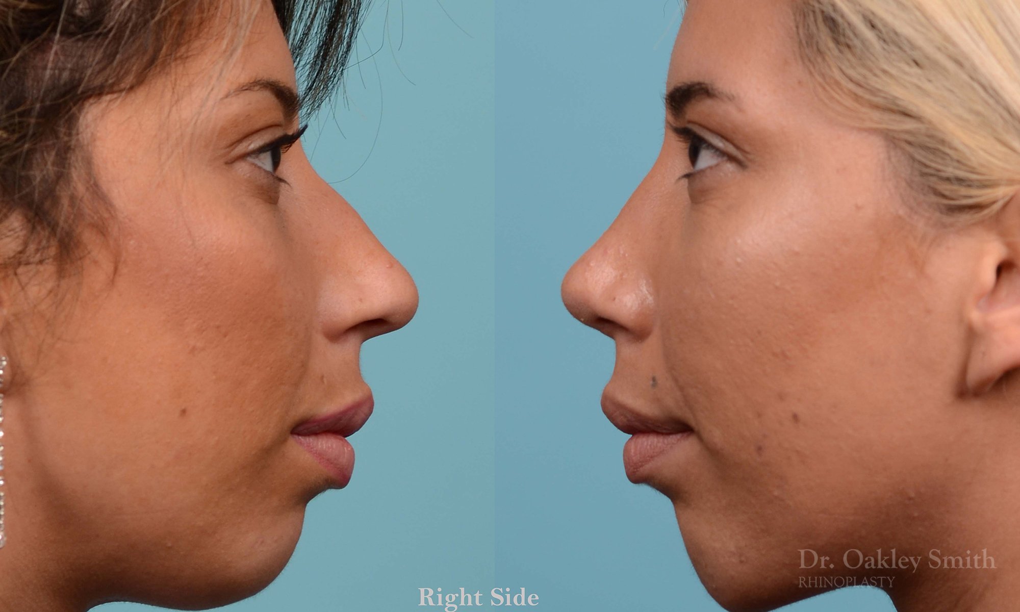 200C-nose-job-rhinoplasty-toronto-dr.-oakley-smith-septum-2.jpg