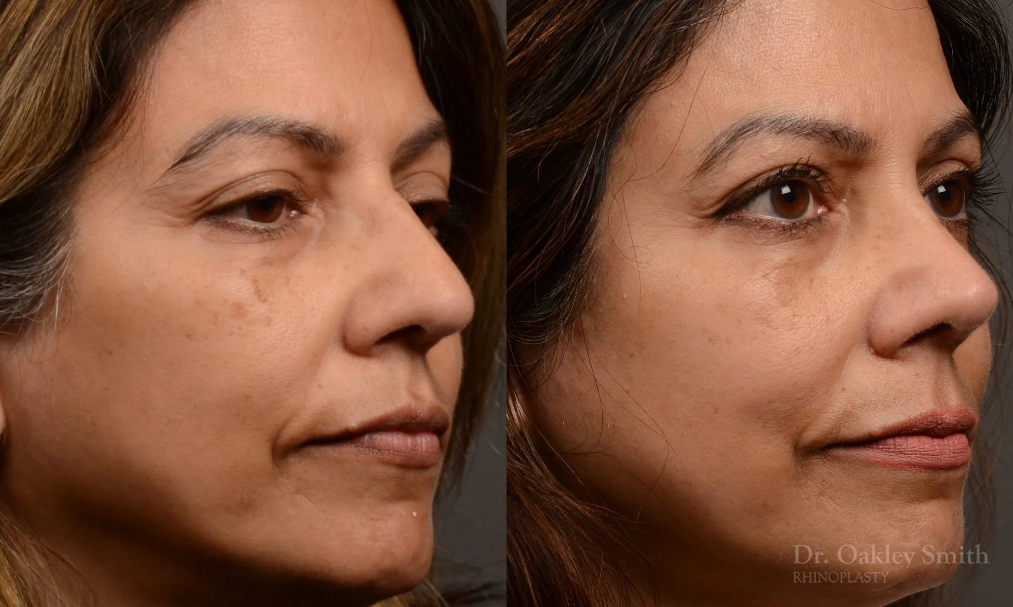 500B-rhinoplasty-dr-oakley-smith-toronto-top-surgeon-nose-job.jpg