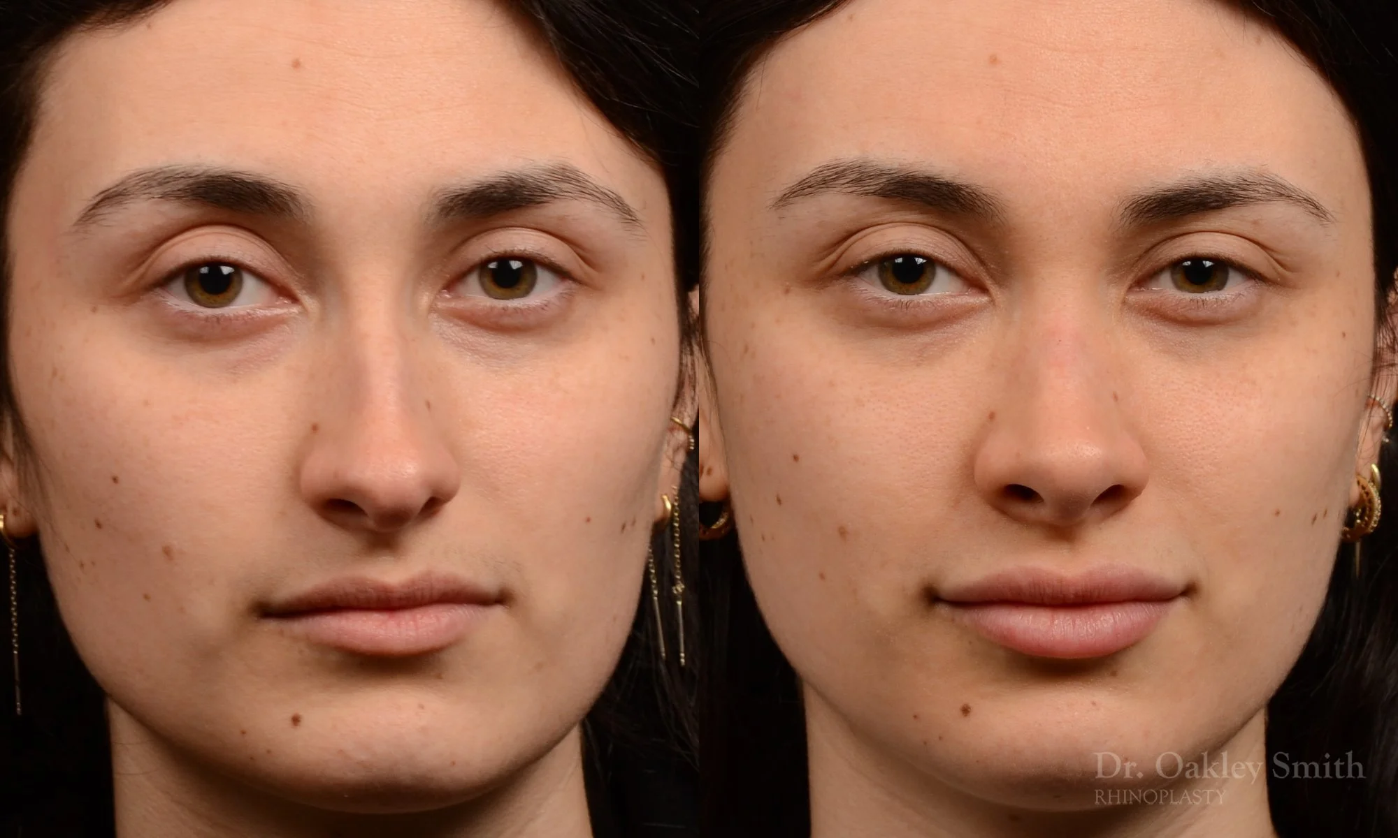 506A-rhinoplasty-dr-oakley-smith-toronto-top-surgeon-nose-job.jpg