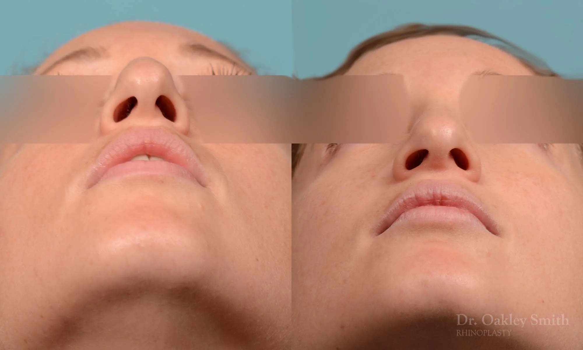 255F-rhinoplasty-dr-oakley-smith-toronto-female-nose-job.jpg