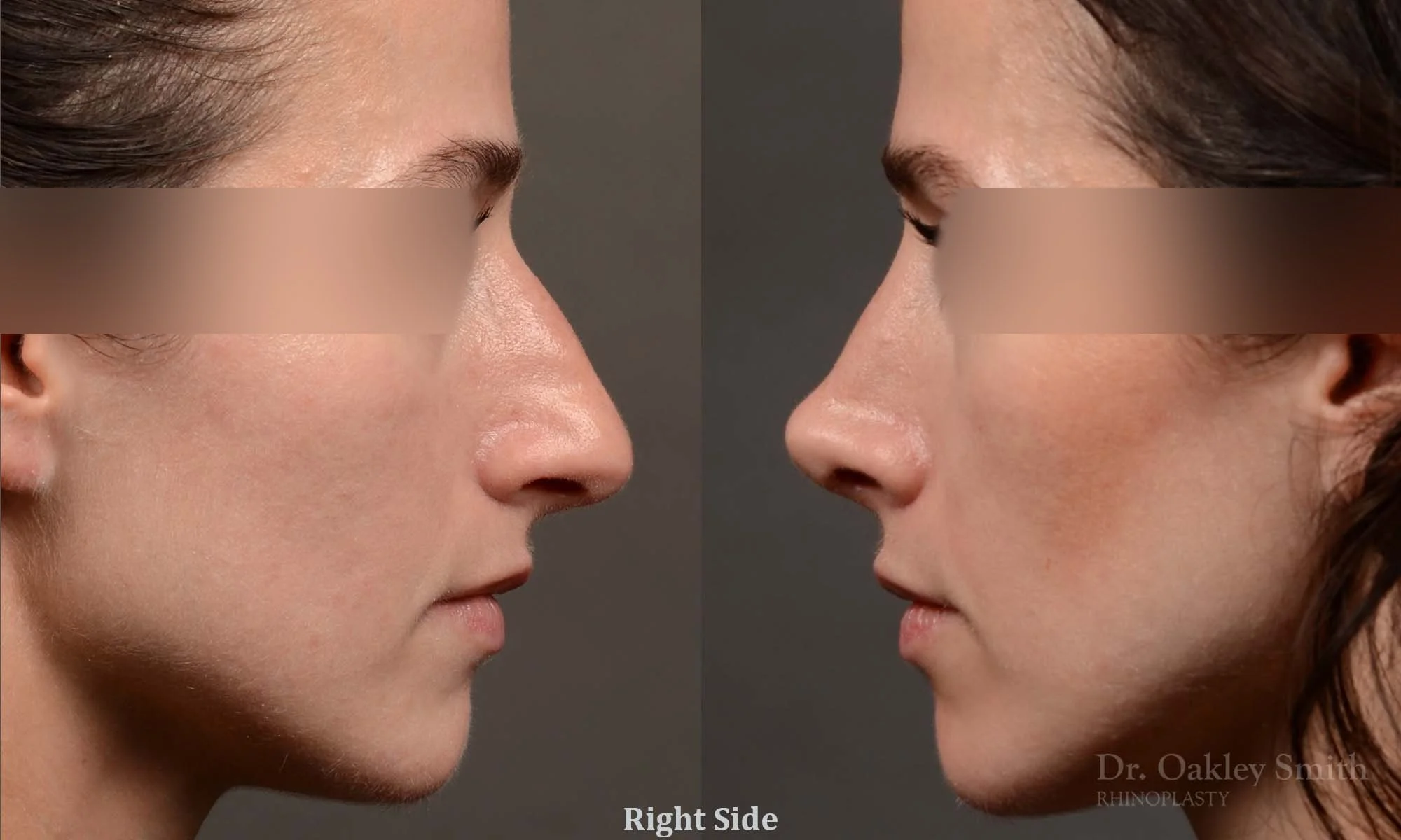 529C-rhinoplasty-dr-oakley-smith-toronto-top-surgeon-nose-job.jpg