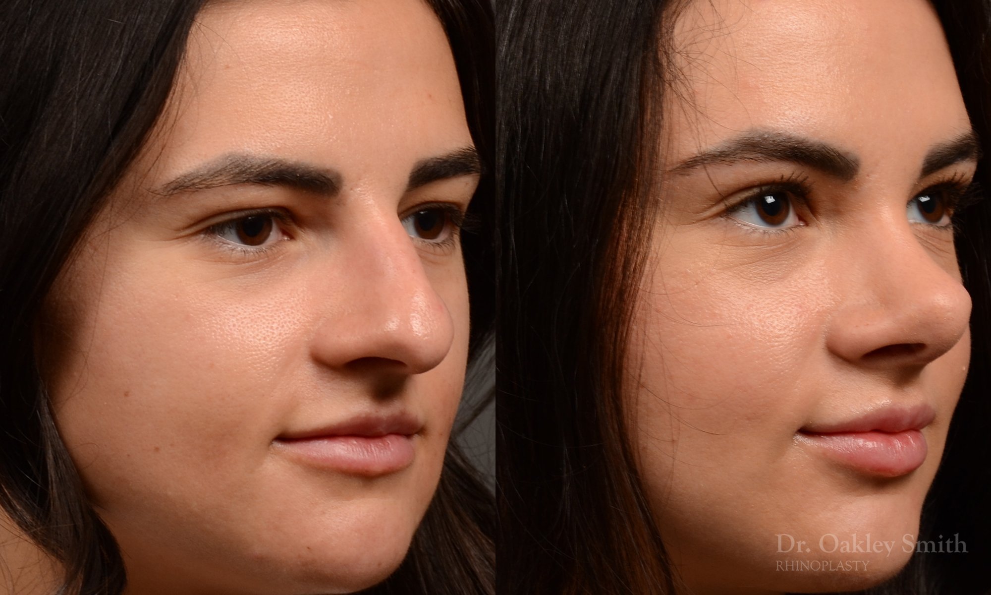 509B-rhinoplasty-dr-oakley-smith-toronto-top-surgeon-nose-job.jpg