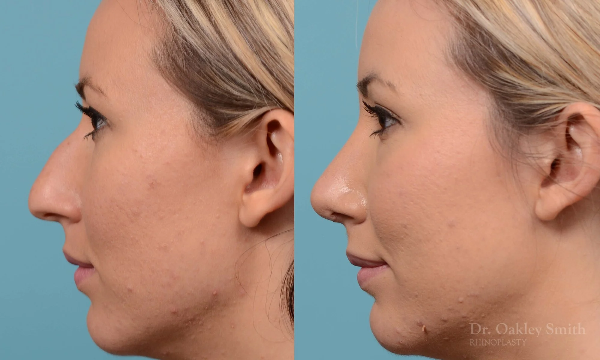 213E-rhinoplasty-toronto-dr-oakley-smith-big-nose-nose-job-curved-straight-profile-columellar-raised-1.jpg