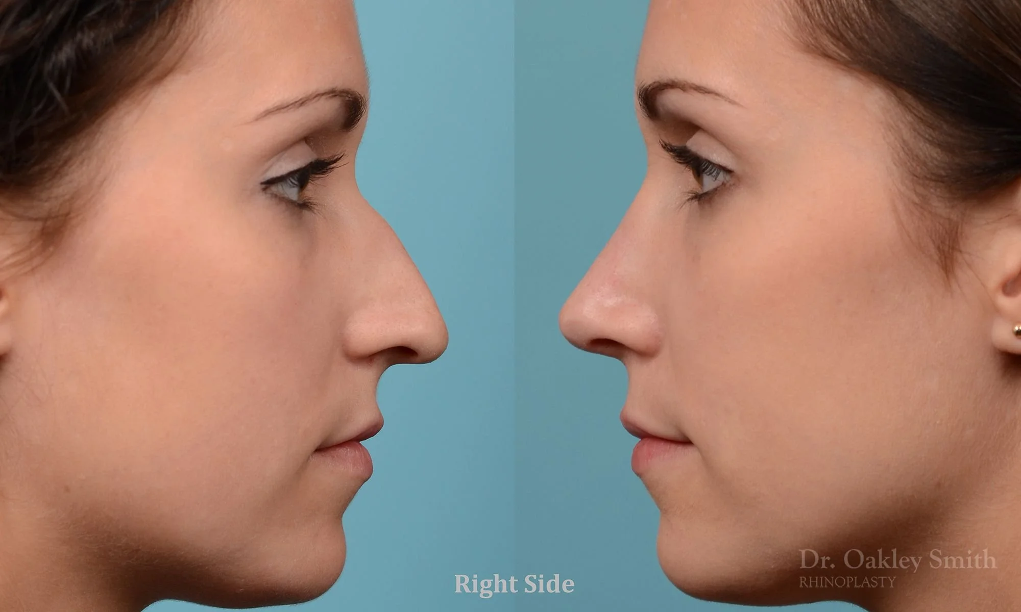 224: Female, Primary Rhinoplasty, Thin Skin, Dorsal Bump, Tip Rotation
