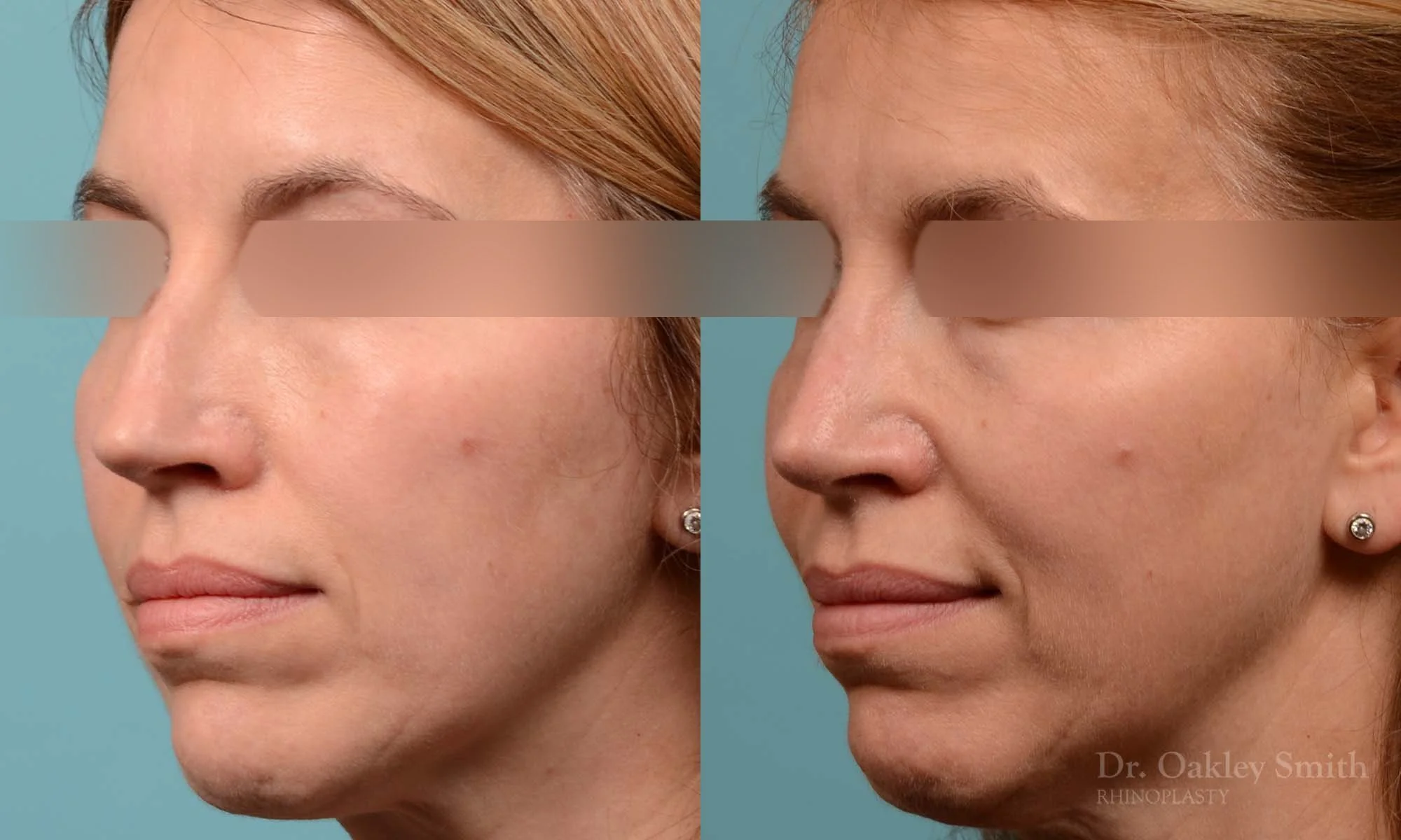 291D-rhinoplasty-dr-oakley-smith-toronto-nose-job.jpg