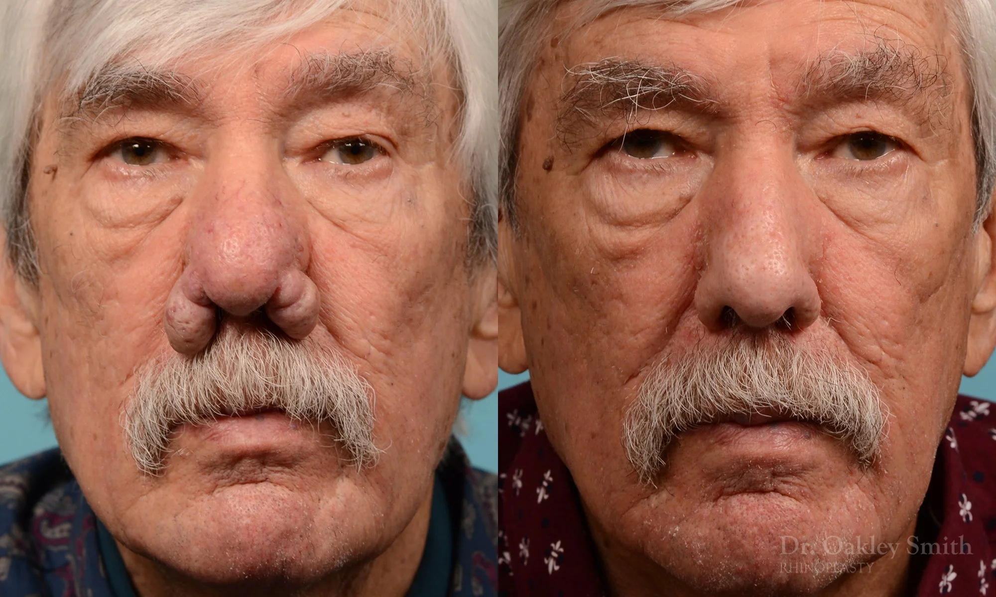 227A-rhinophyma-rhinoplasty-dr-oakley-smith-toronto-nose-job-1.jpg