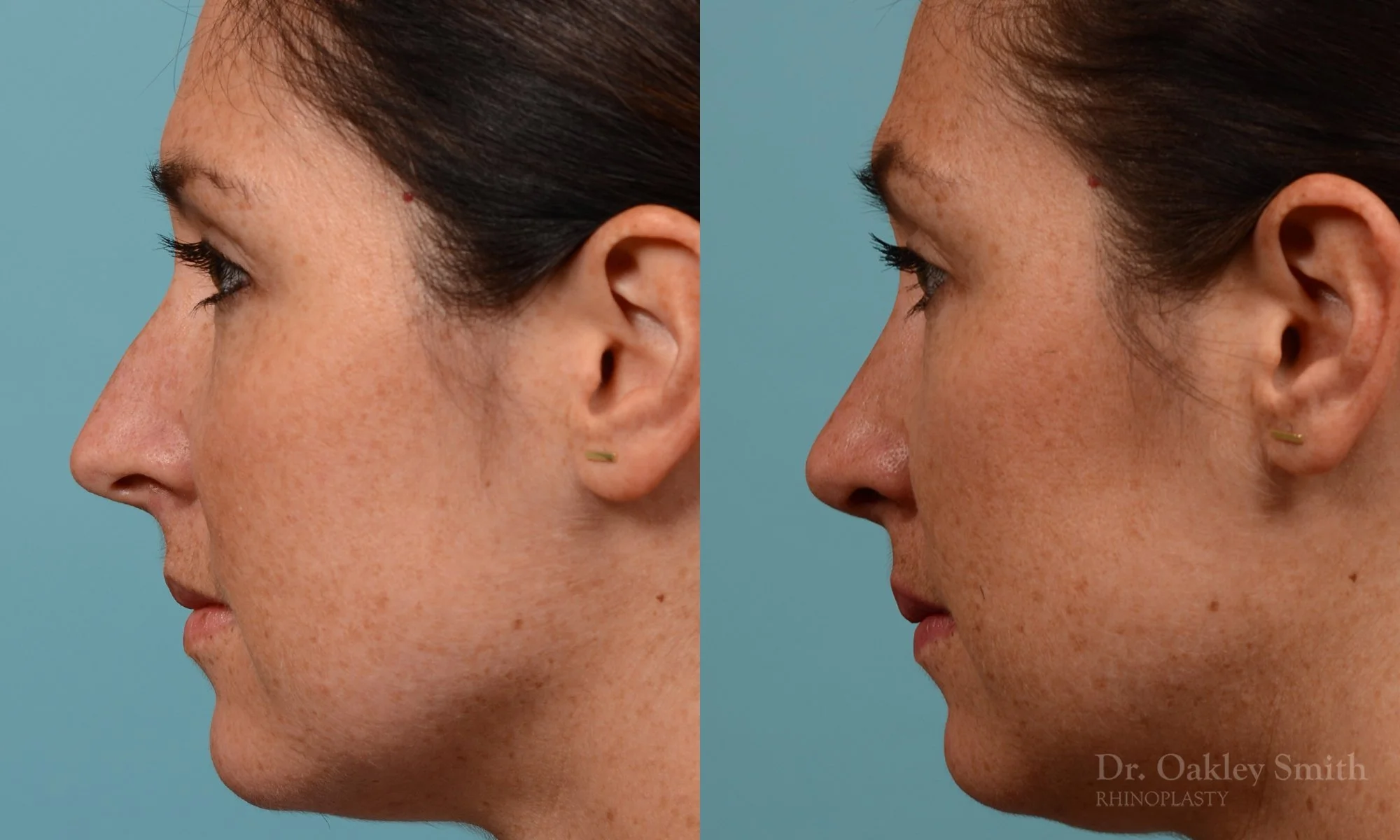 302E-rhinoplasty-dr-oakley-smith-toronto-nose-job.jpg