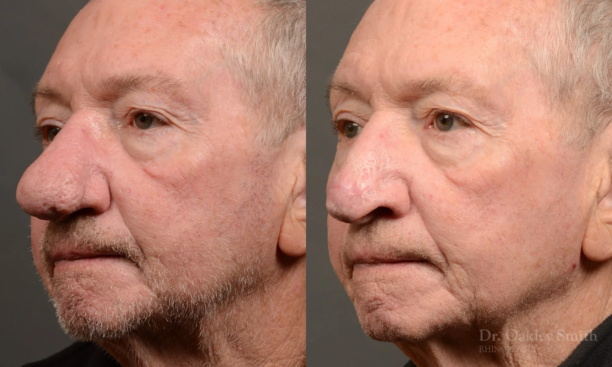 Case 548 dr oakley smith, male rhinophyma, 12 months after surgery, left oblique view.jpg