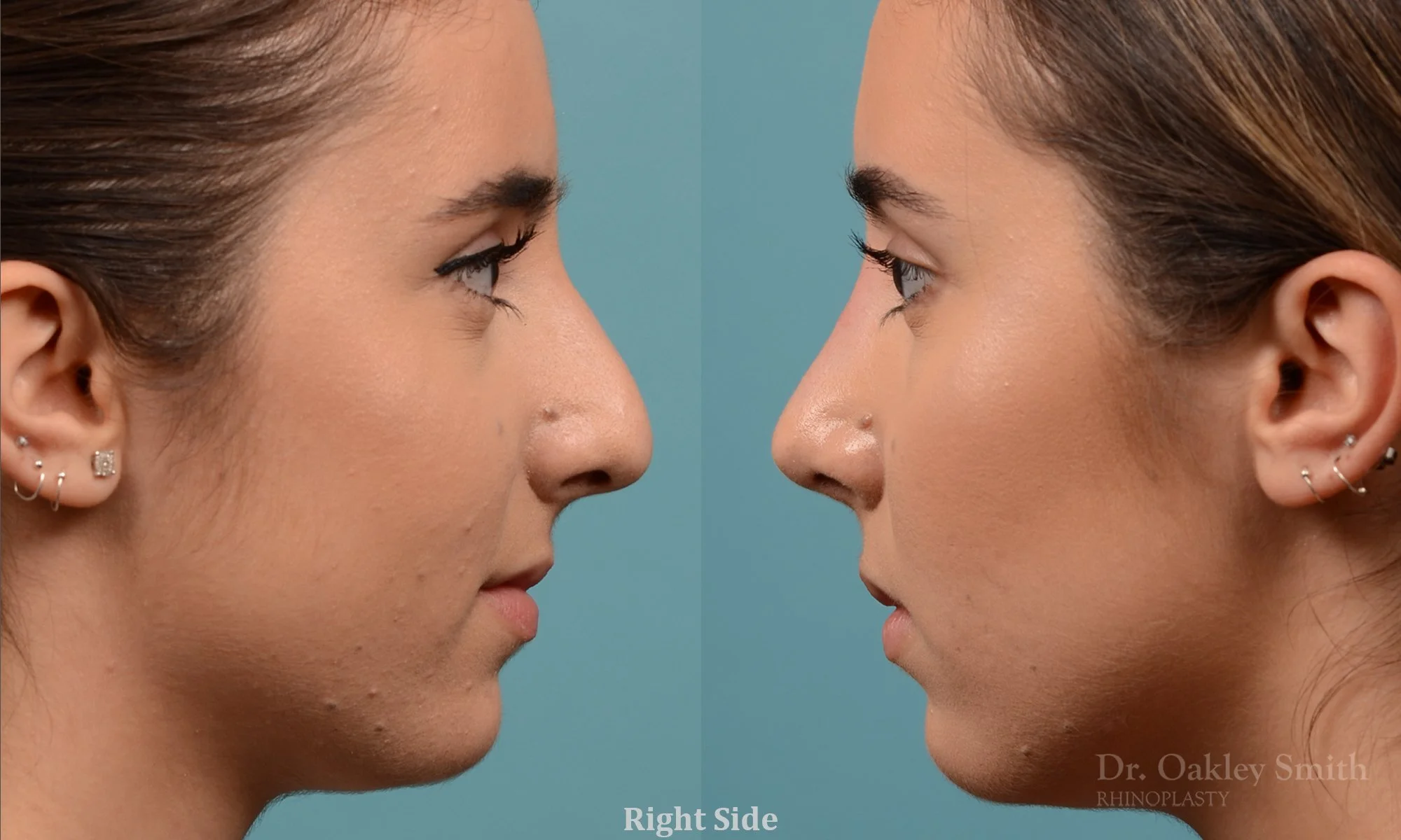 301: Female Rhinoplasty, Dorsal Hump, Tip Refinement, Crooked