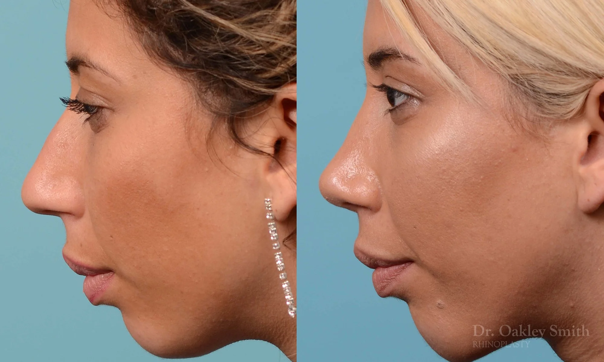 200E-nose-job-rhinoplasty-toronto-dr.-oakley-smith-septum-3.jpg