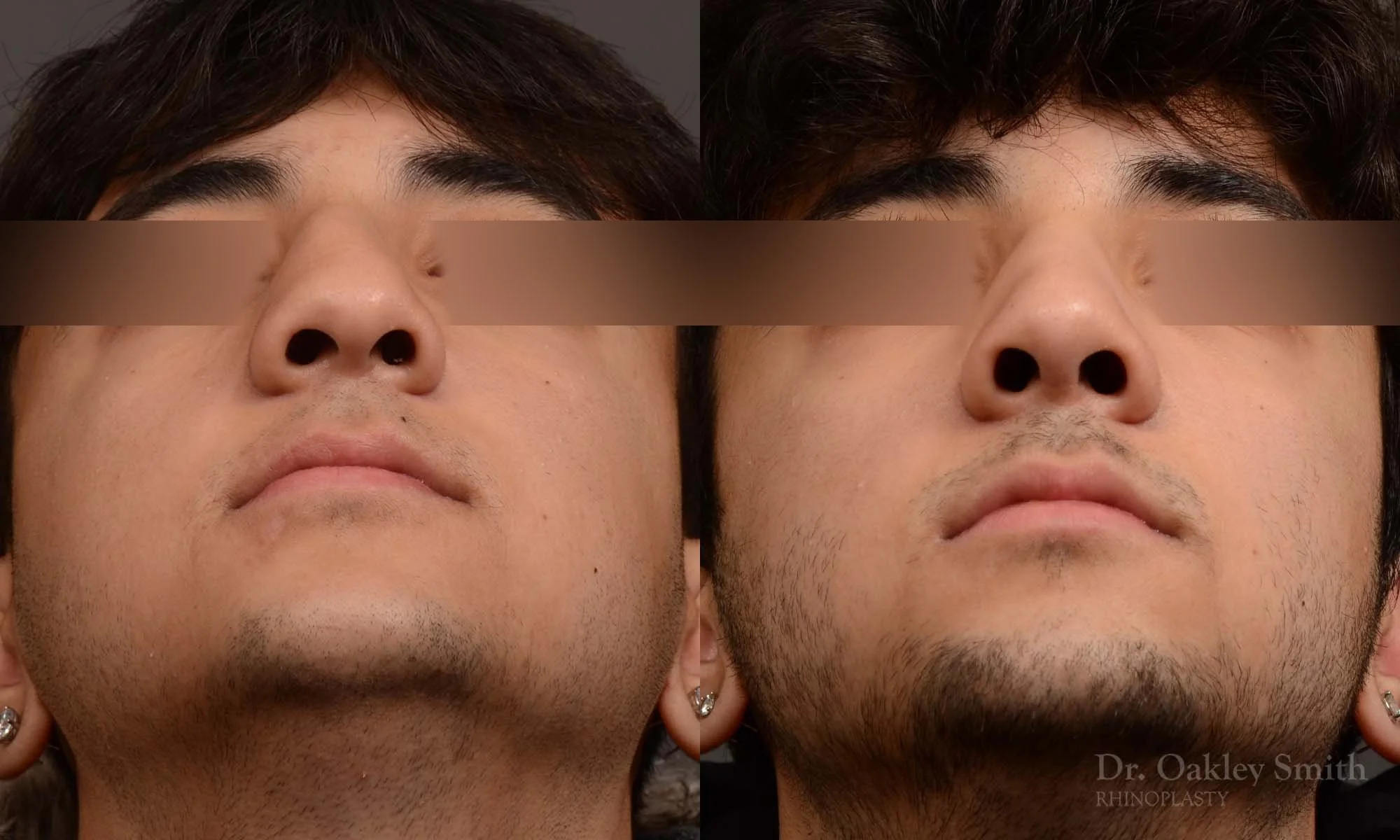 520F-male-rhinoplasty-dr-oakley-smith-toronto-top-surgeon-nose-job.jpg
