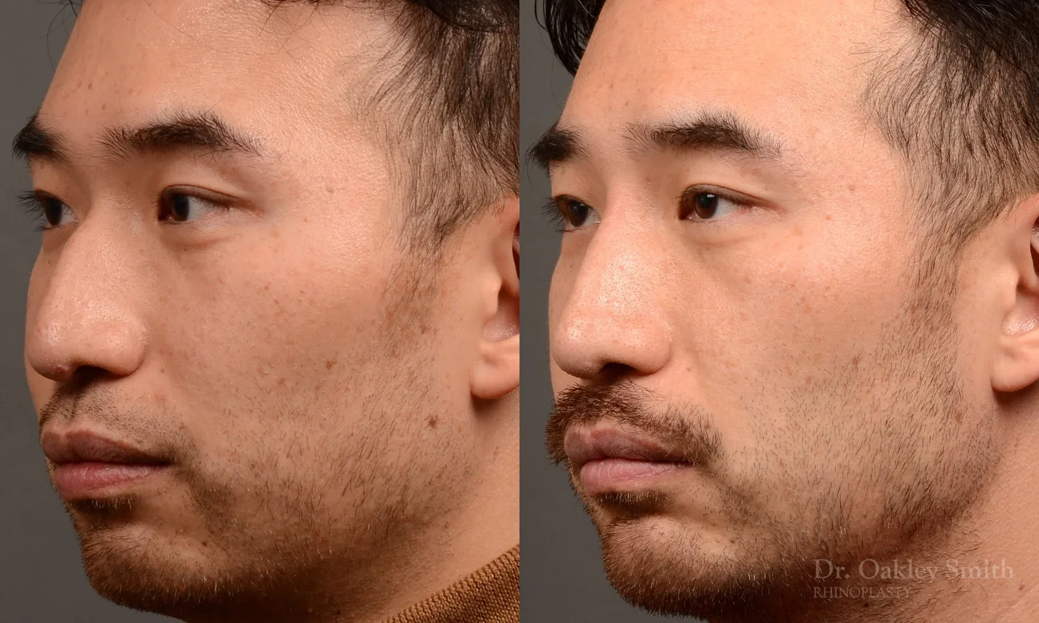 552D-rhinoplasty-filler-nose-job-toronto-nose-surgeon-dr-oakley-smith.webp