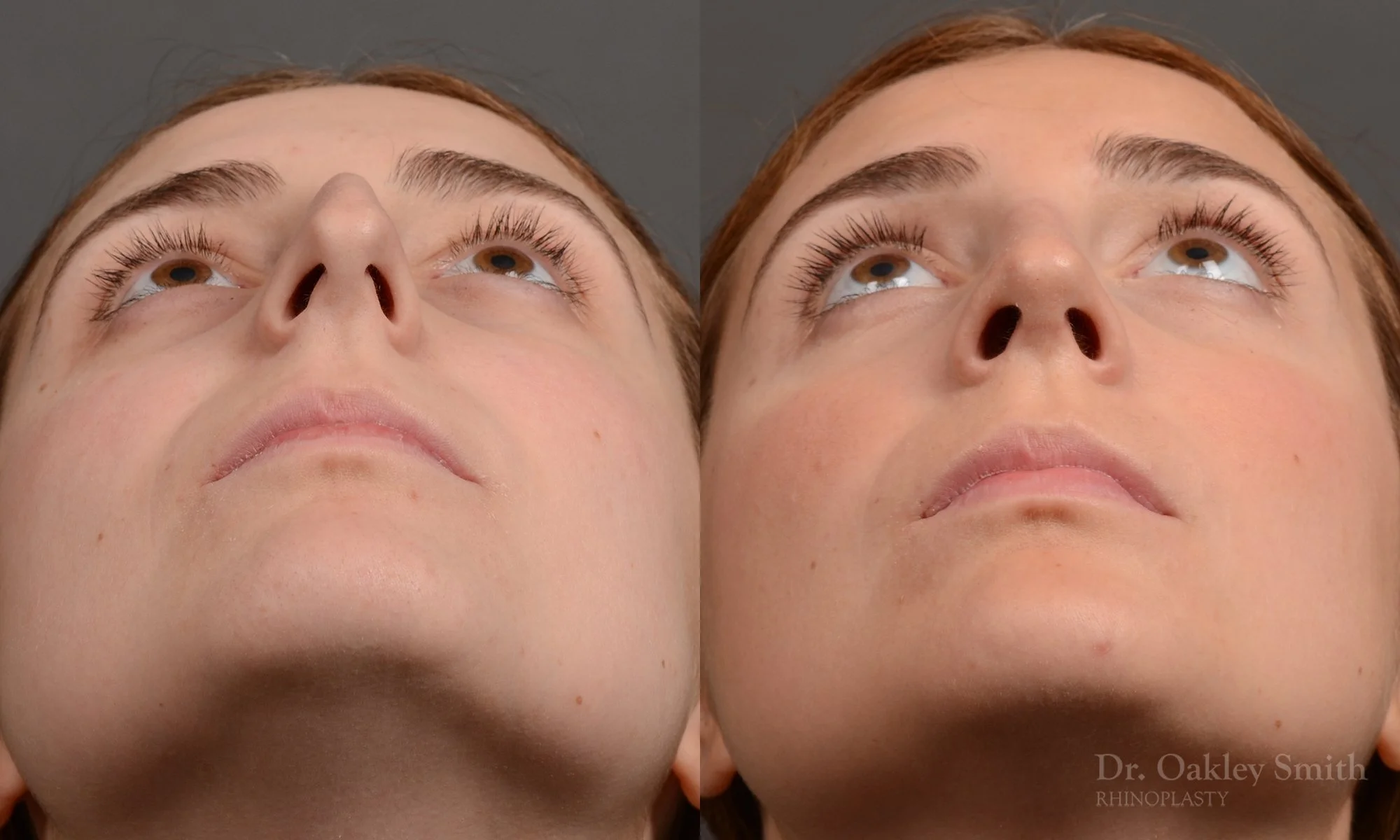 305F-rhinoplasty-dr-oakley-smith-toronto-nose-job.jpg