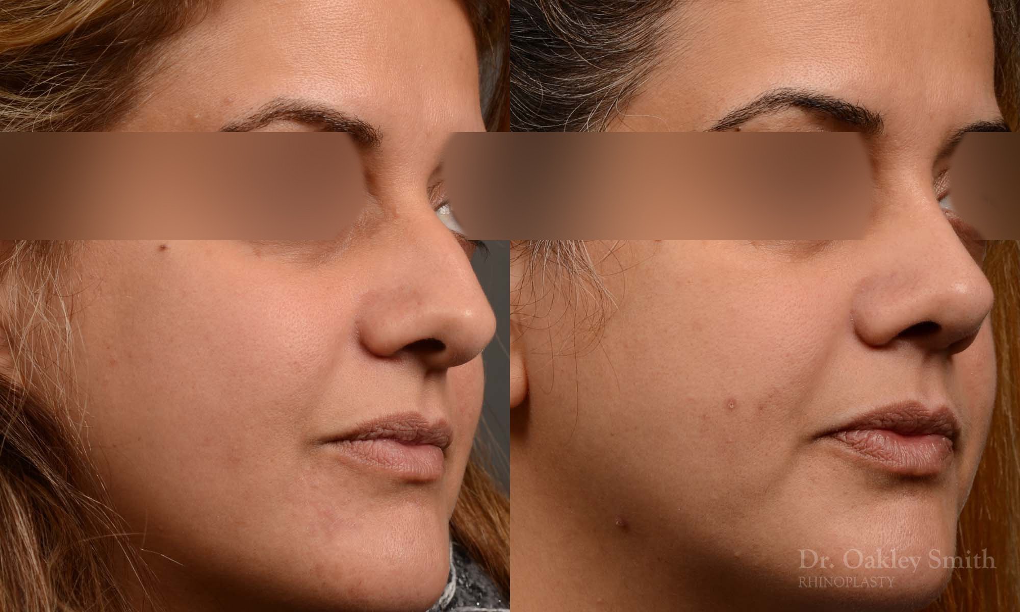 527B-rhinoplasty-dr-oakley-smith-toronto-top-surgeon-nose-job.jpg
