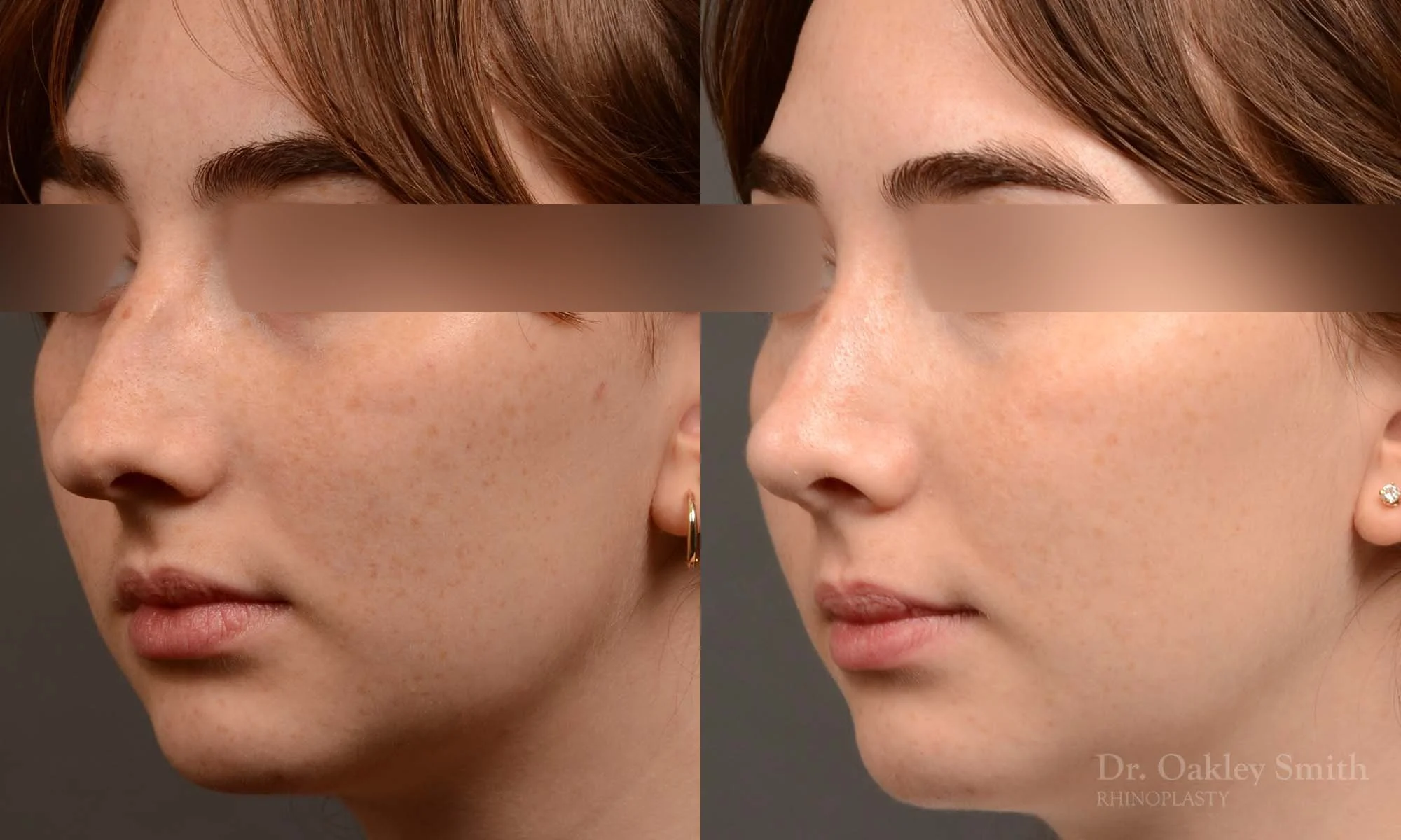 551D-rhinoplasty-nose-job-toronto-nose-surgeon-dr-oakley-smith.jpg