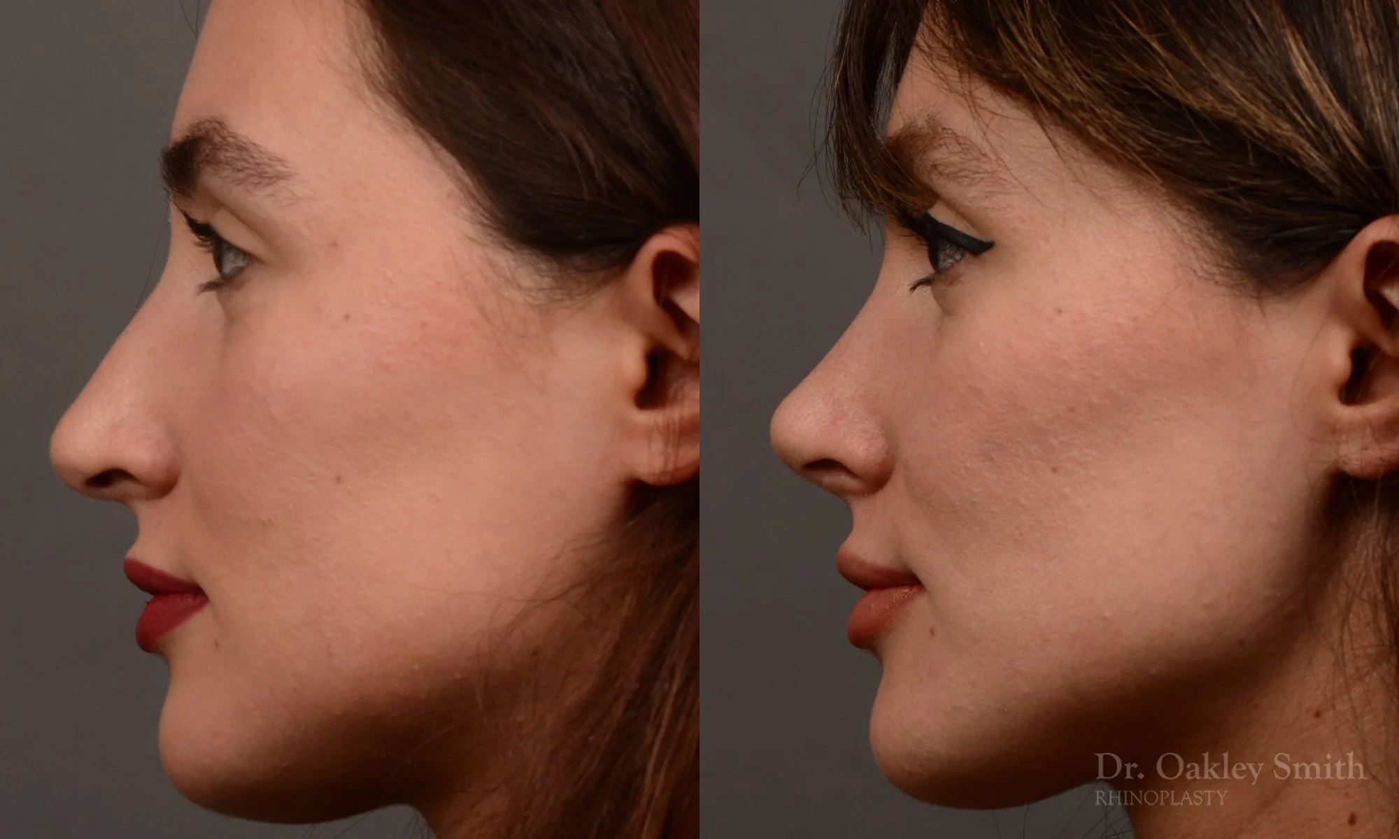 526E-rhinoplasty-dr-oakley-smith-toronto-top-surgeon-nose-job.jpg