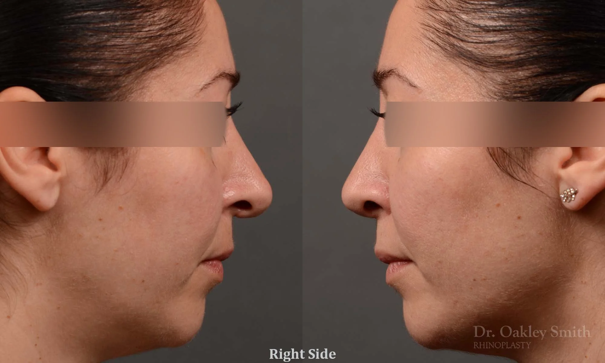 331: Female, Revision Rhinoplasty, Tip Reconstruction