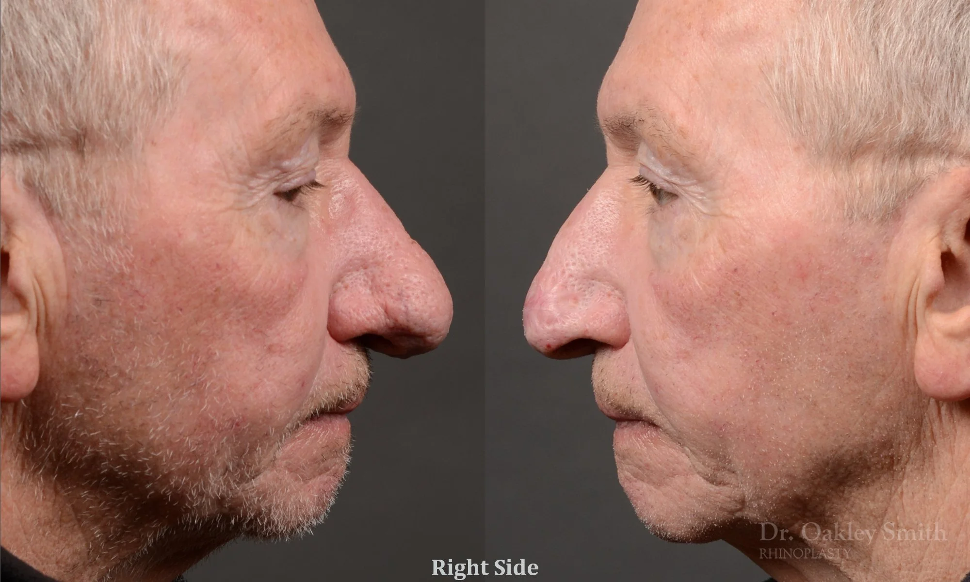 Case 548 dr oakleysmith, male rhinophyma, 12 months after surgery, right profile.jpg