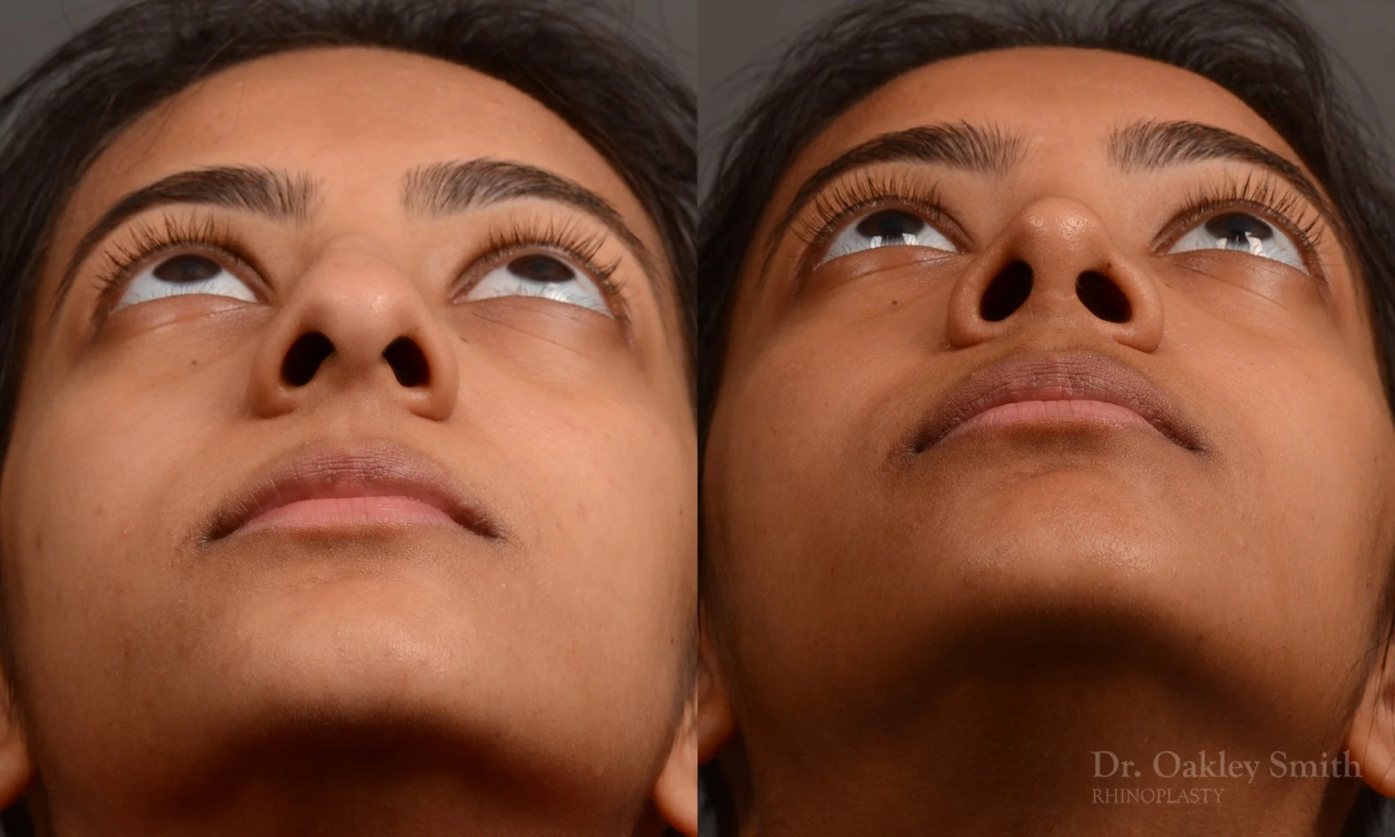 399F-expert-rhinoplasty-dr-oakley-smith-toronto-nose-job.jpg
