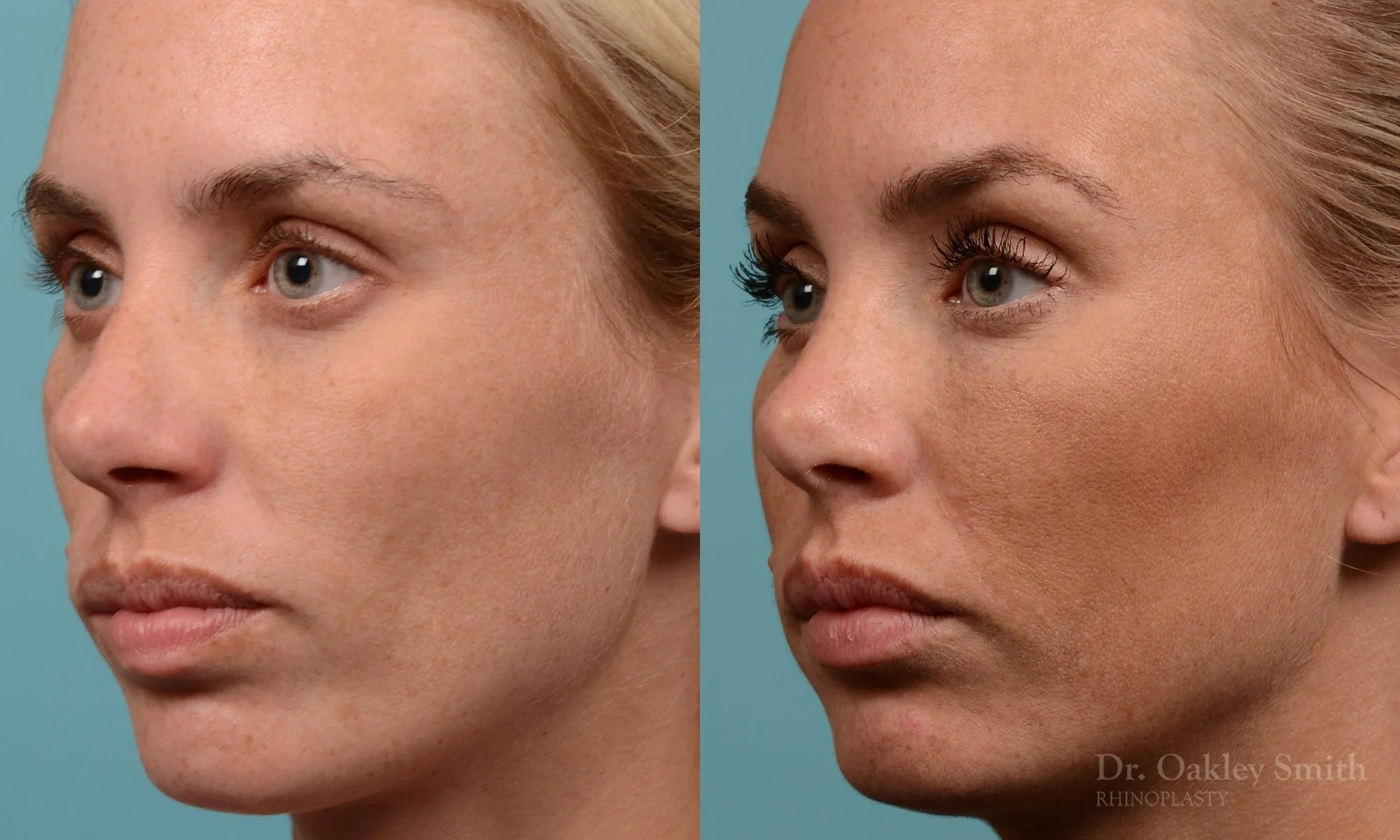 284D-rhinoplasty-dr-oakley-smith-toronto-nose-job.jpg