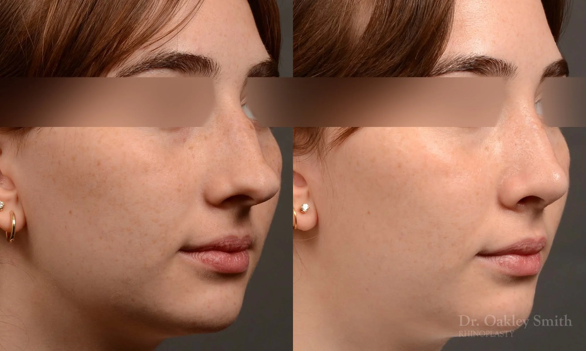 551B-rhinoplasty-nose-job-toronto-nose-surgeon-dr-oakley-smith.jpg