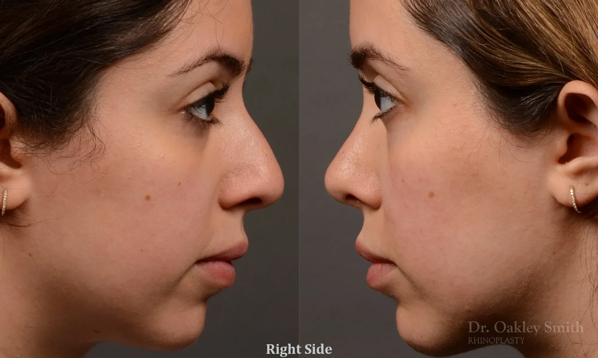 507: Female, Ethnic Rhinoplasty, Thick Skin, Dorsal Hump, Tip Refinemen, Crookedt