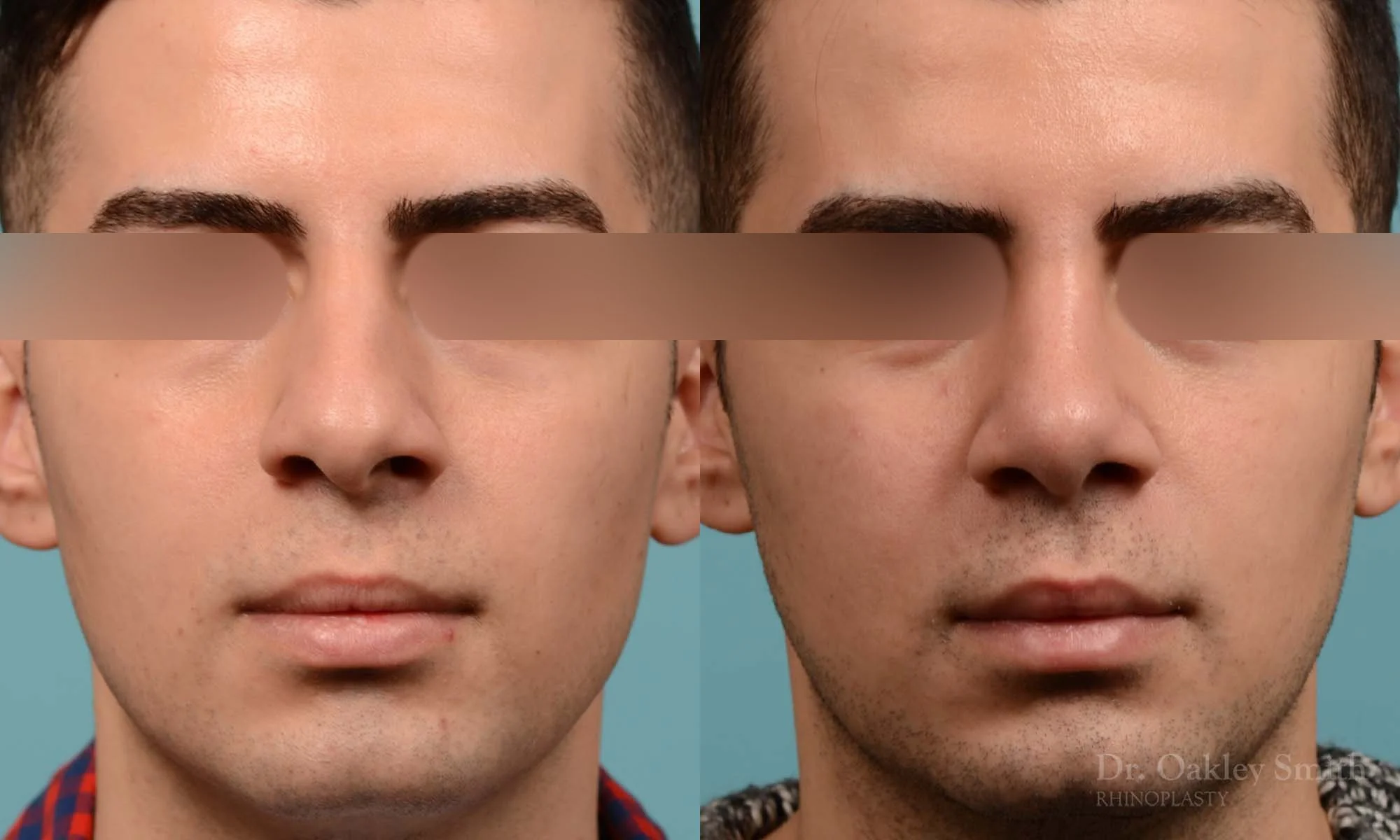 253A-rhinoplasty-dr-oakley-smith-toronto-male-nose-job.jpg