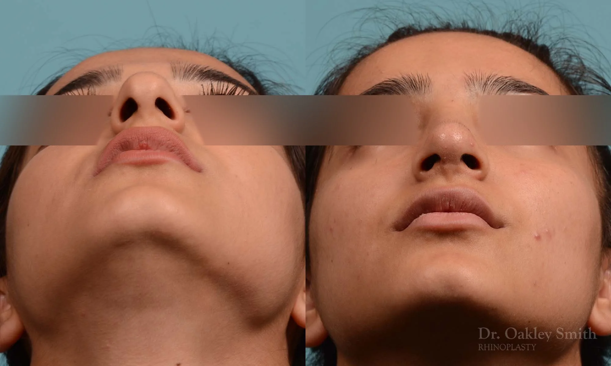 308F-rhinoplasty-dr-oakley-smithm-toronto-nose-job.jpg