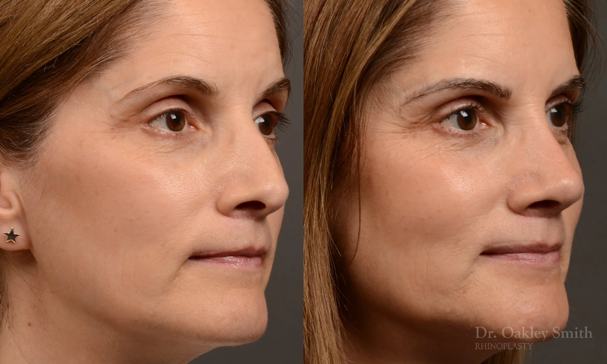 546B-rhinoplasty-nose-job-top-toronto-surgeon-dr-oakley-smith.jpg