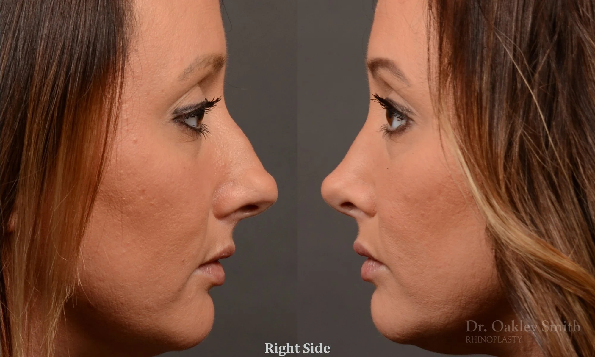 499C-rhinoplasty-dr-oakley-smith-toronto-top-surgeon-nose-job.jpg