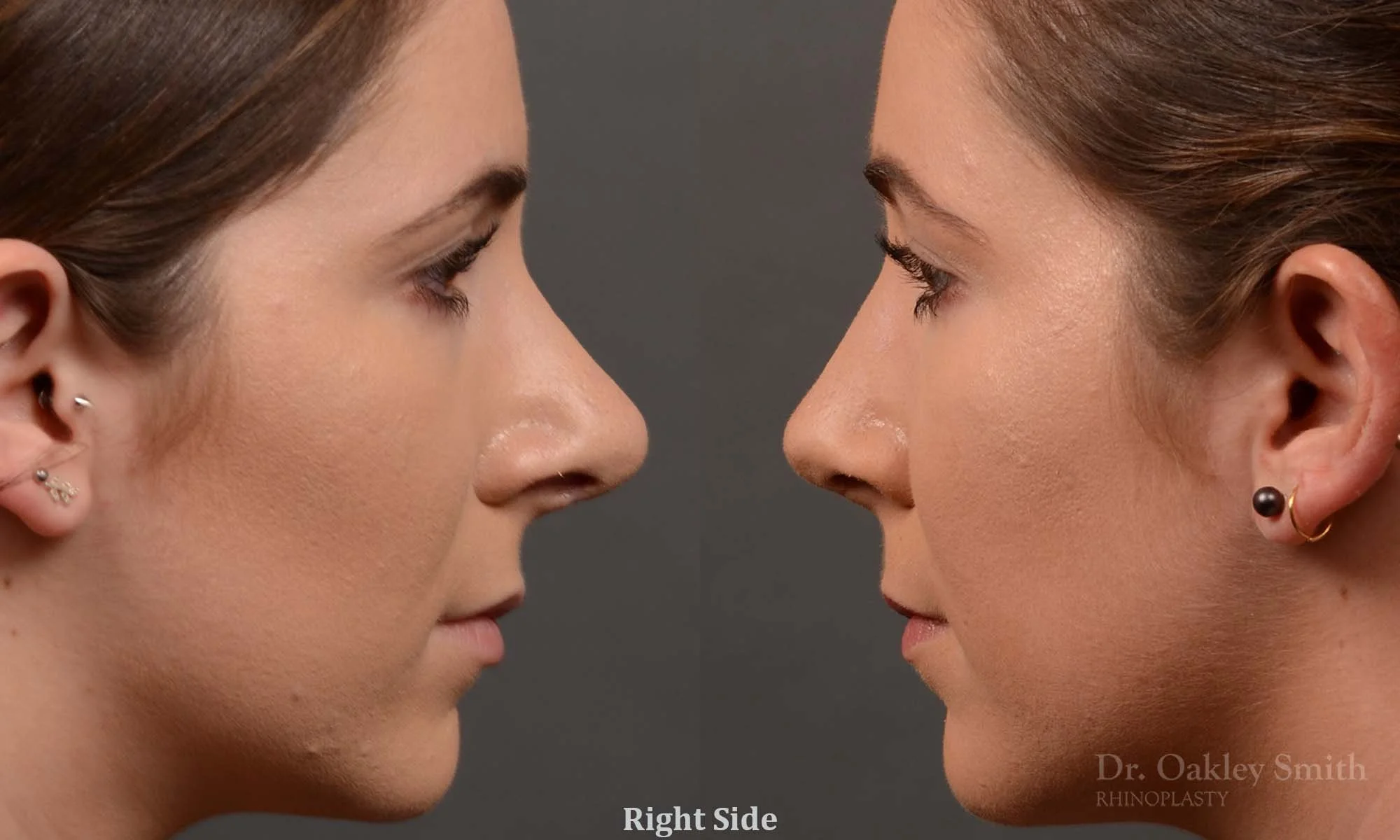 366C-rhinoplasty-dr-oakley-smith-toronto-nose-job.jpg