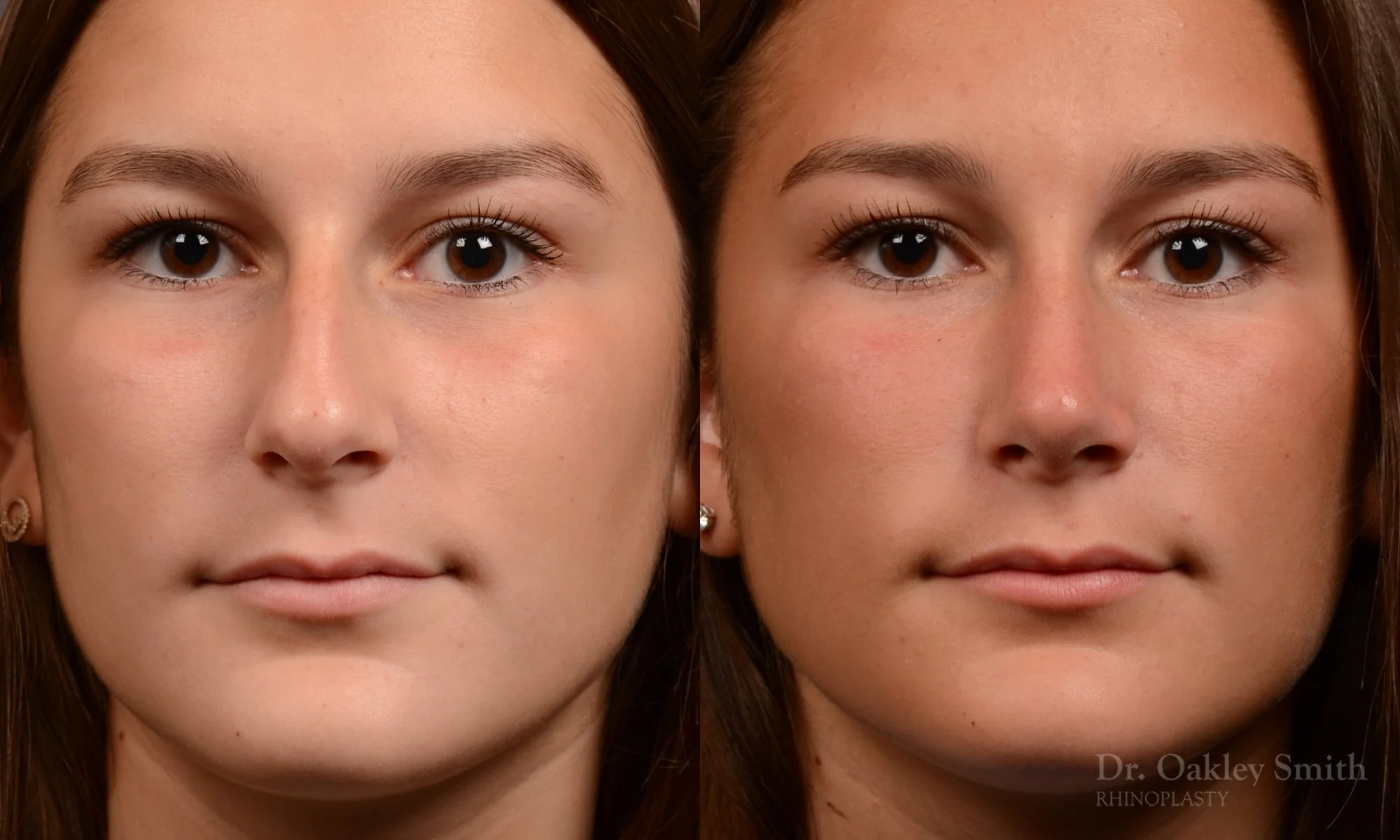 517A-rhinoplasty-dr-oakley-smith-toronto-top-surgeon-nose-job.jpg