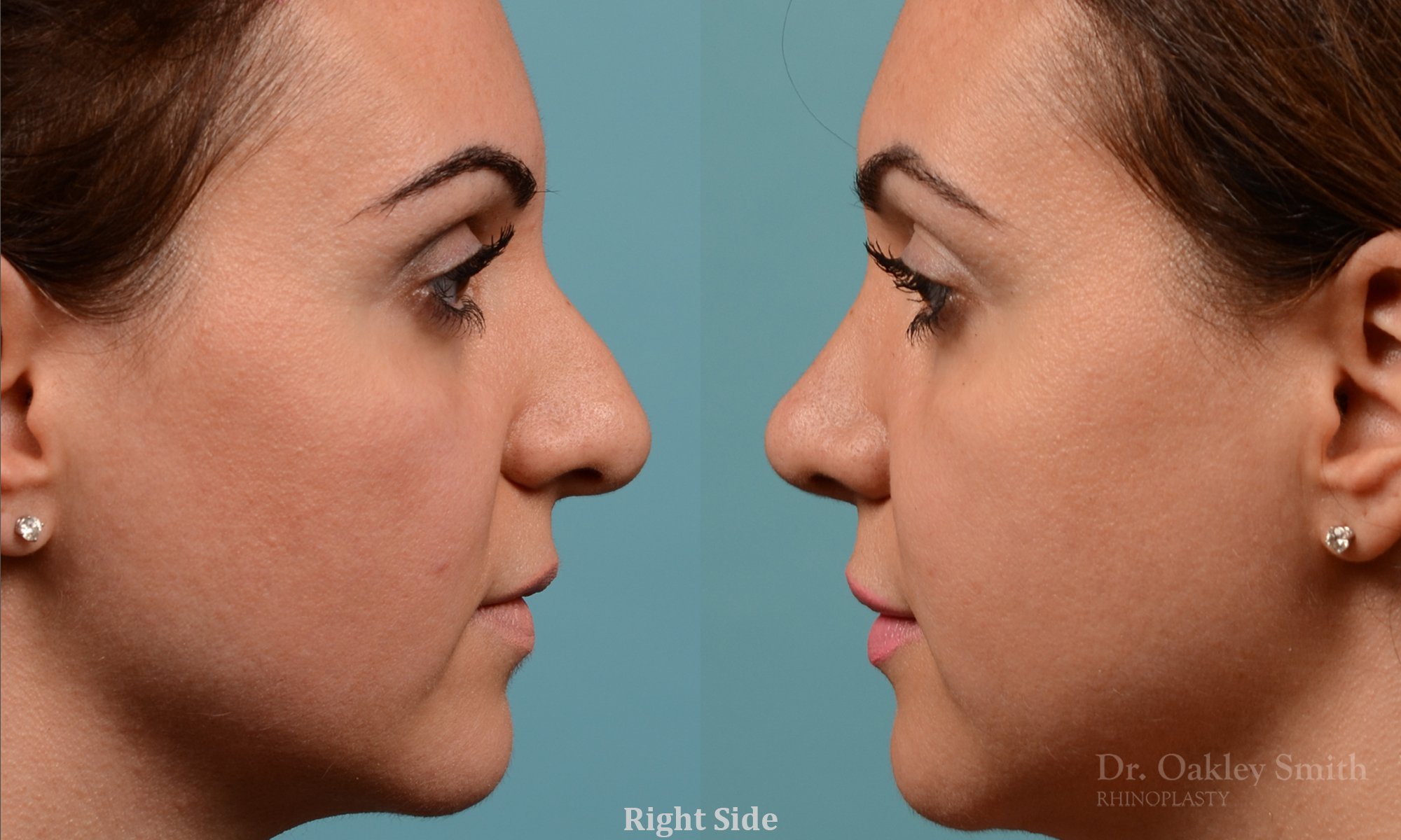 311: Female, Ethnic Rhinoplasty, Thick Skin, Dorsal Hump, Tip Refinement