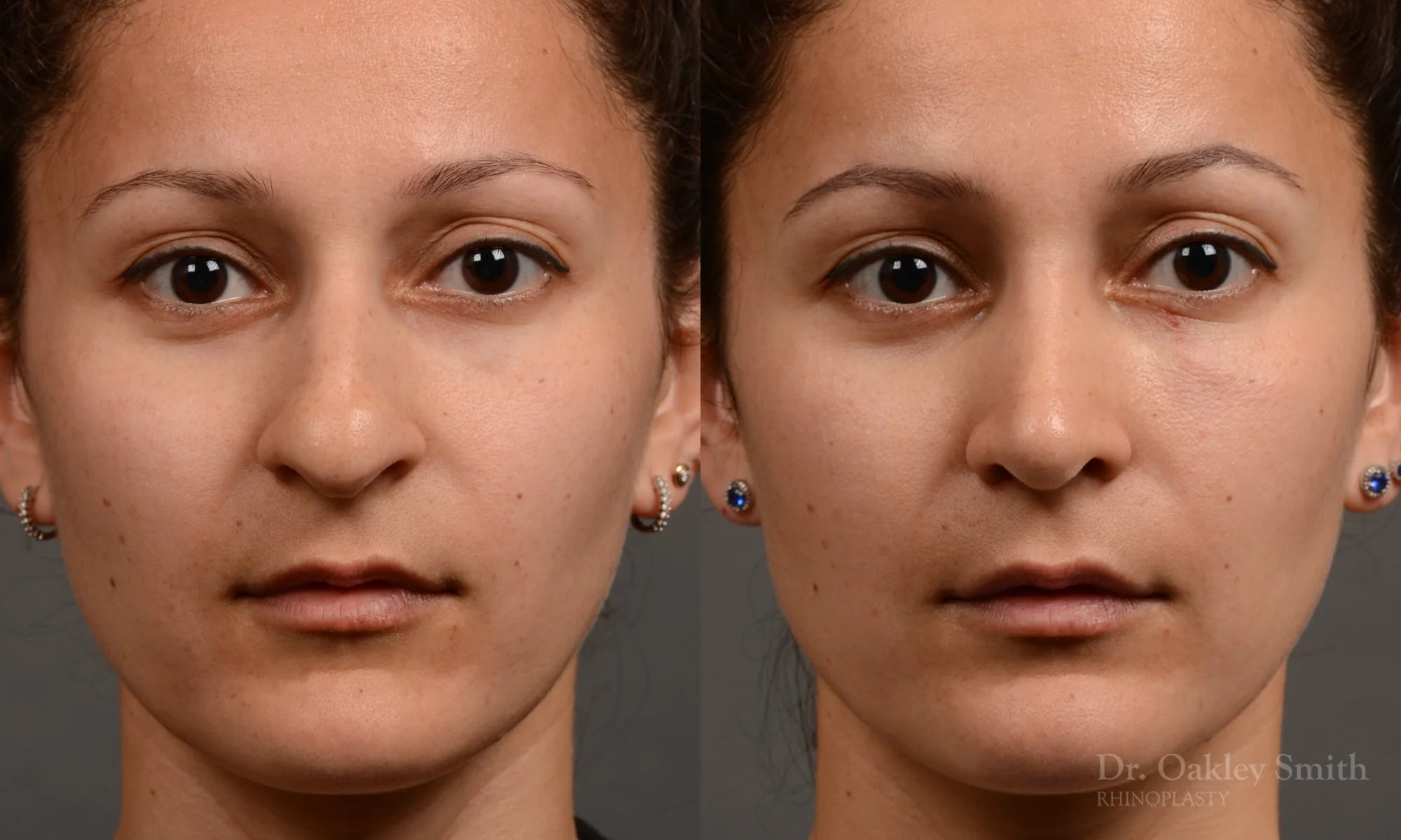 332A-rhinoplasty-dr-oakley-smith-toronto-nose-job.jpg