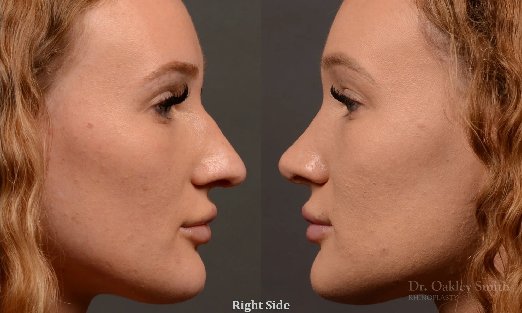 491C-rhinoplasty-dr-oakley-smith-toronto-top-surgeon-nose-job.jpg