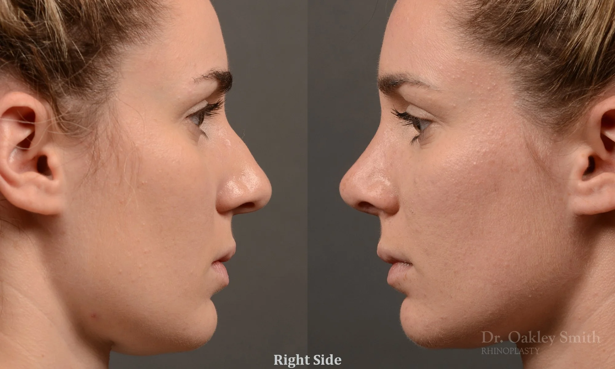 358: Female Rhinoplasty, Dorsal Hump, Subtle Tip Narrowing