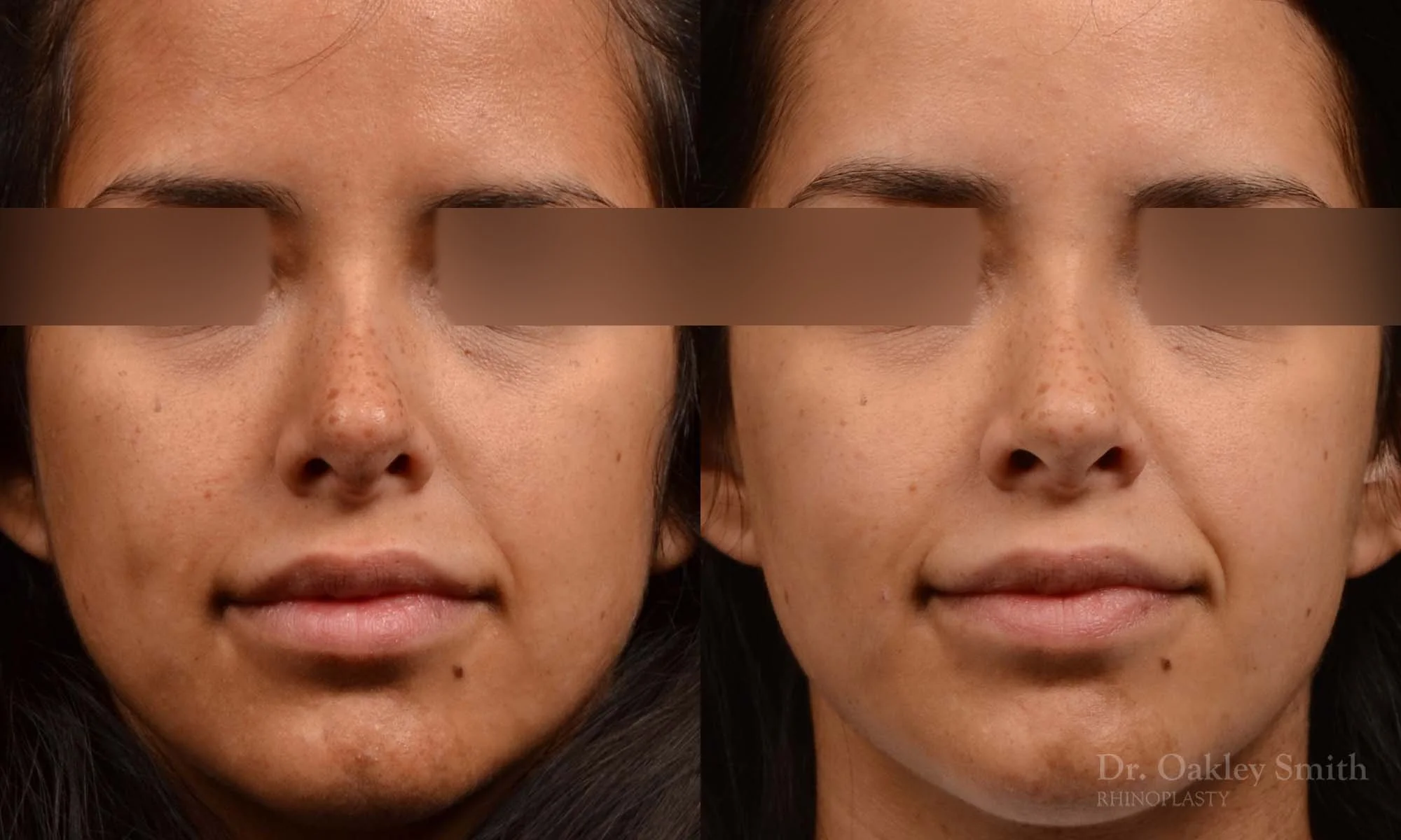 492A-rhinoplasty-dr-oakley-smith-toronto-top-surgeon-nose-job.jpg