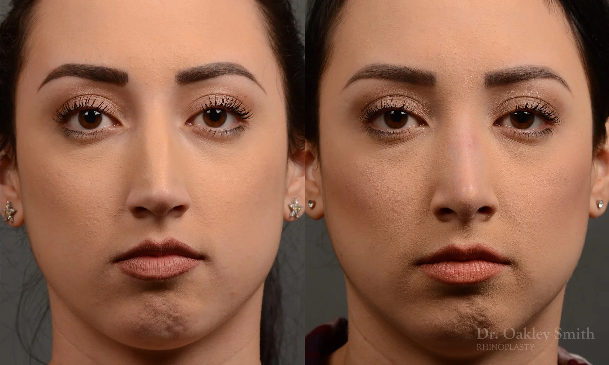 340.1A-rhinoplasty-dr-oakley-smith-toronto-nose-job.jpg
