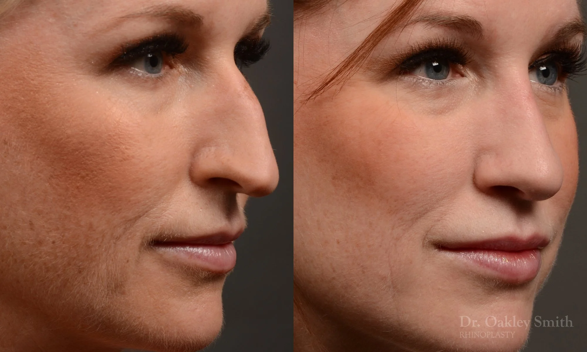 528B-rhinoplasty-dr-oakley-smith-toronto-top-surgeon-nose-job.jpg