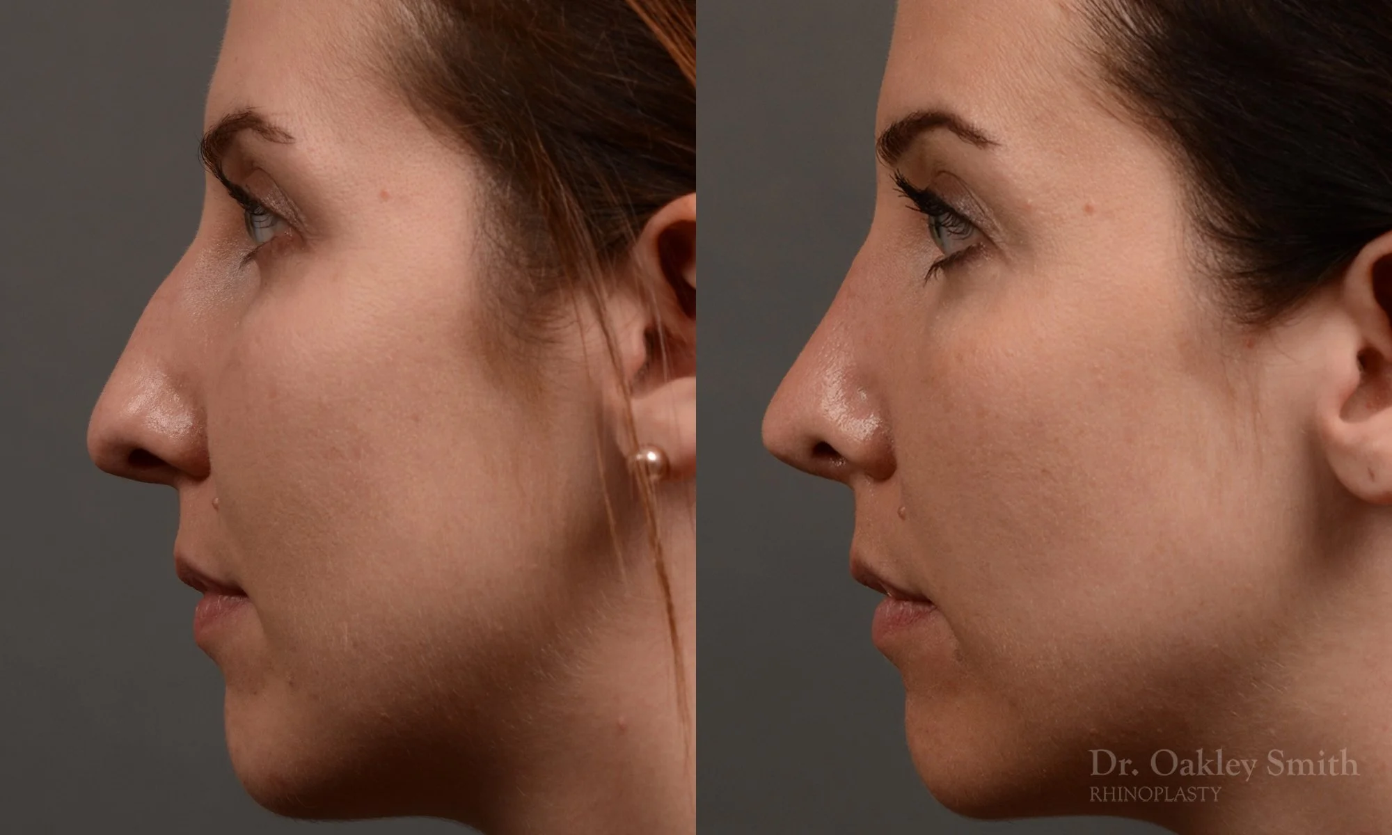357E-rhinoplasty-dr-oakley-smith-toronto-nose-job - Copy.jpg