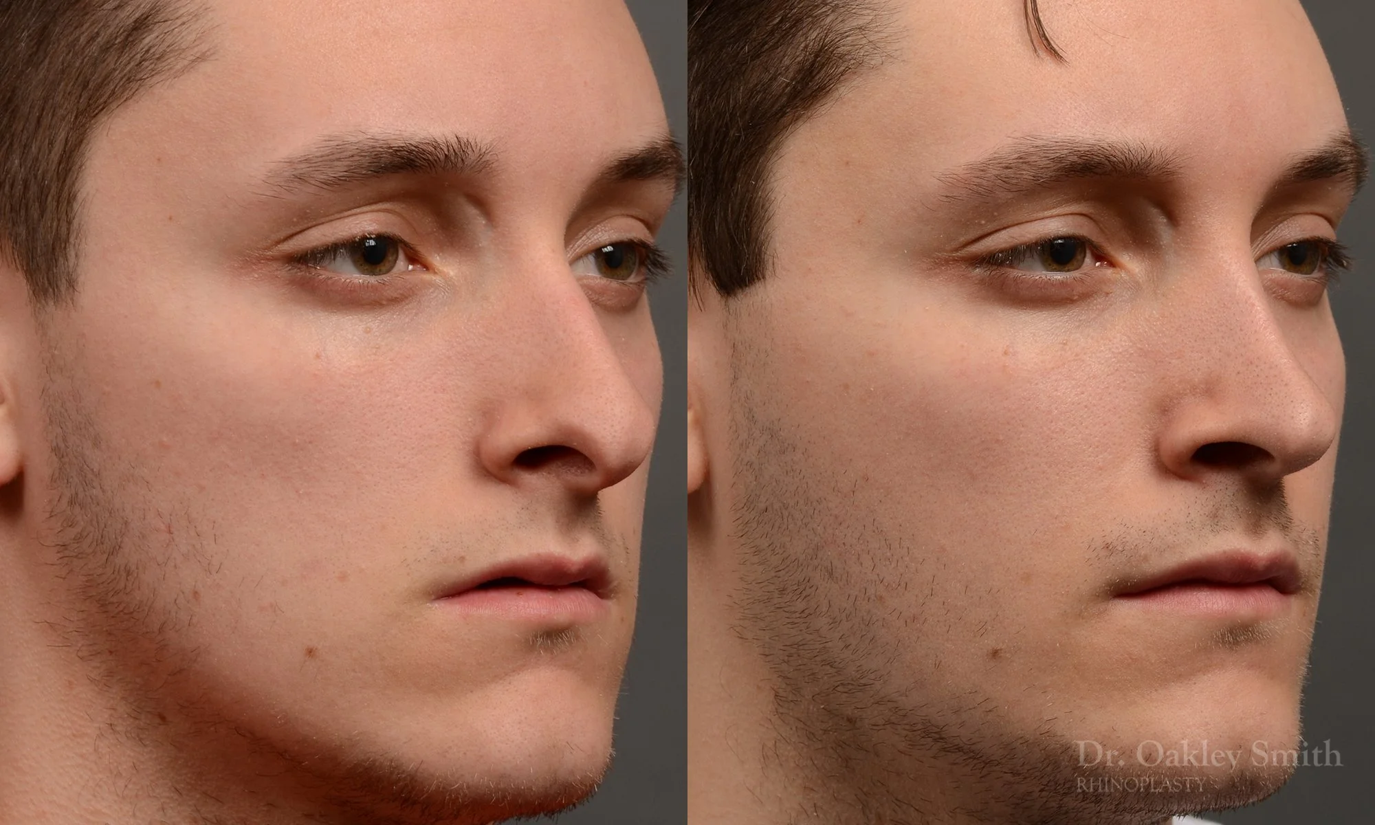 377.1B-rhinoplasty-dr-oakley-smith-toronto-nose-job.jpg