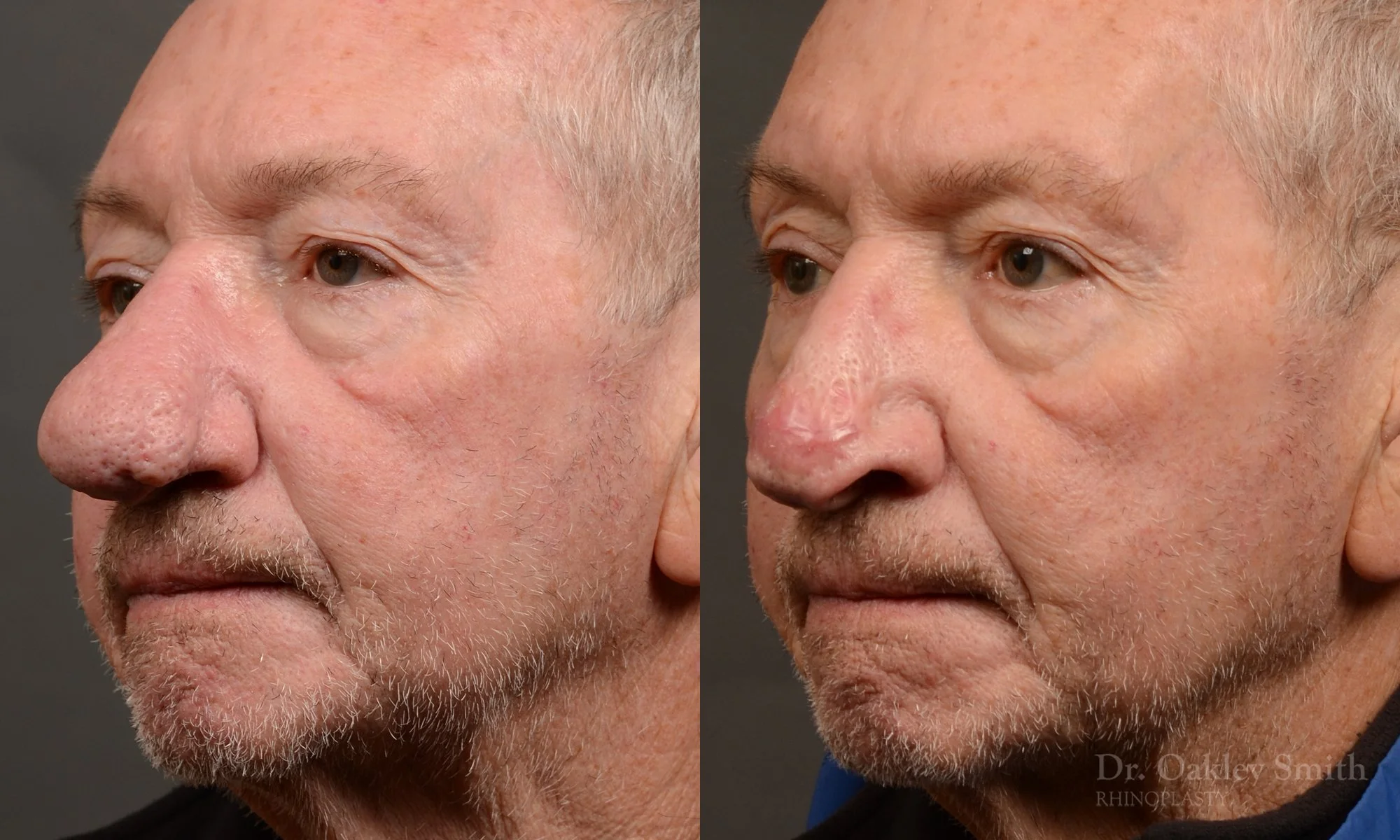 548D-Rhinophyma-nose-job-growth-toronto-nose-surgeon-dr.-oakley-smith.jpg
