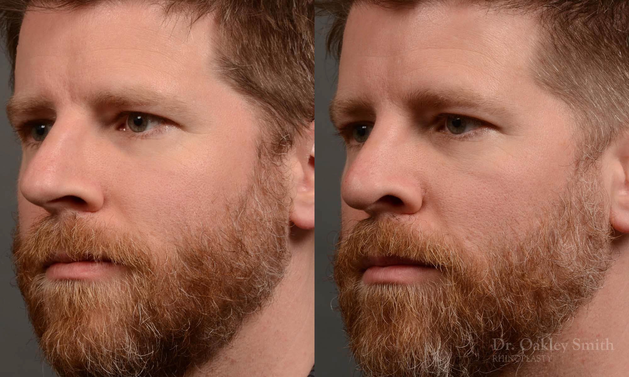 379D-Rhinoplasty-dr-oakley-smith-toronto-male-long-nose-nose-job.jpg